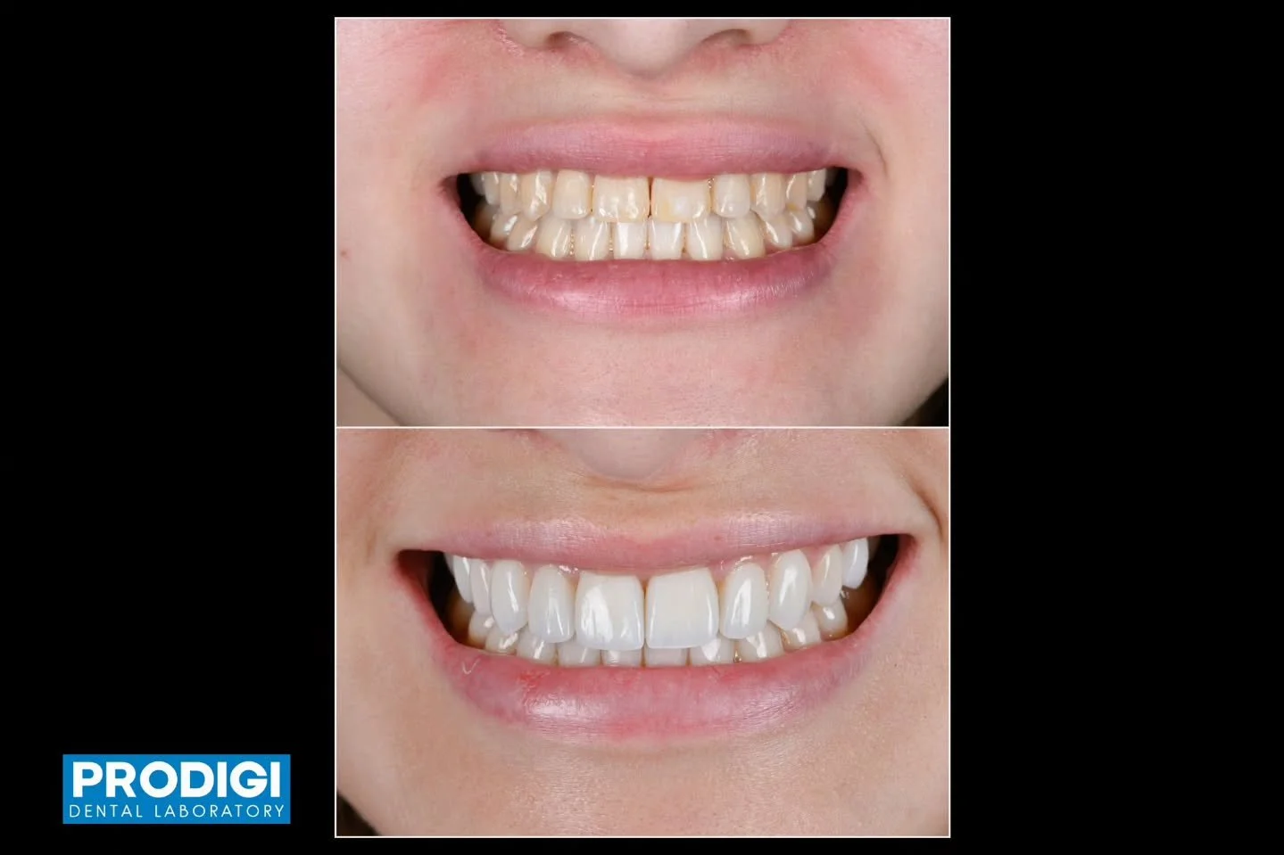 Full maxillary veneers milled from HASS Amber Mill blocks 🦷✨

Enhanced with labial porcelain buildup to create natural translucency, depth, and refined esthetic detail.

Combining the precision of digital milling with the artistry of layered ceramic