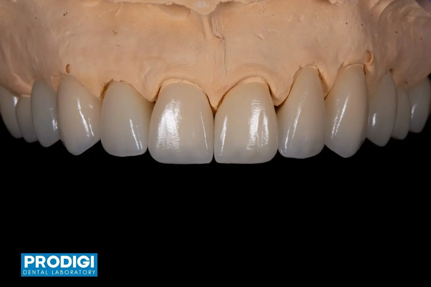 Maxillary zirconia crowns enhanced with micro-layering using Ivoclar Ceram Art and GC initial Zir powders 🦷✨

Combining the strength of zirconia with carefully layered ceramics to create natural translucency, depth, texture, and lifelike esthetics.
