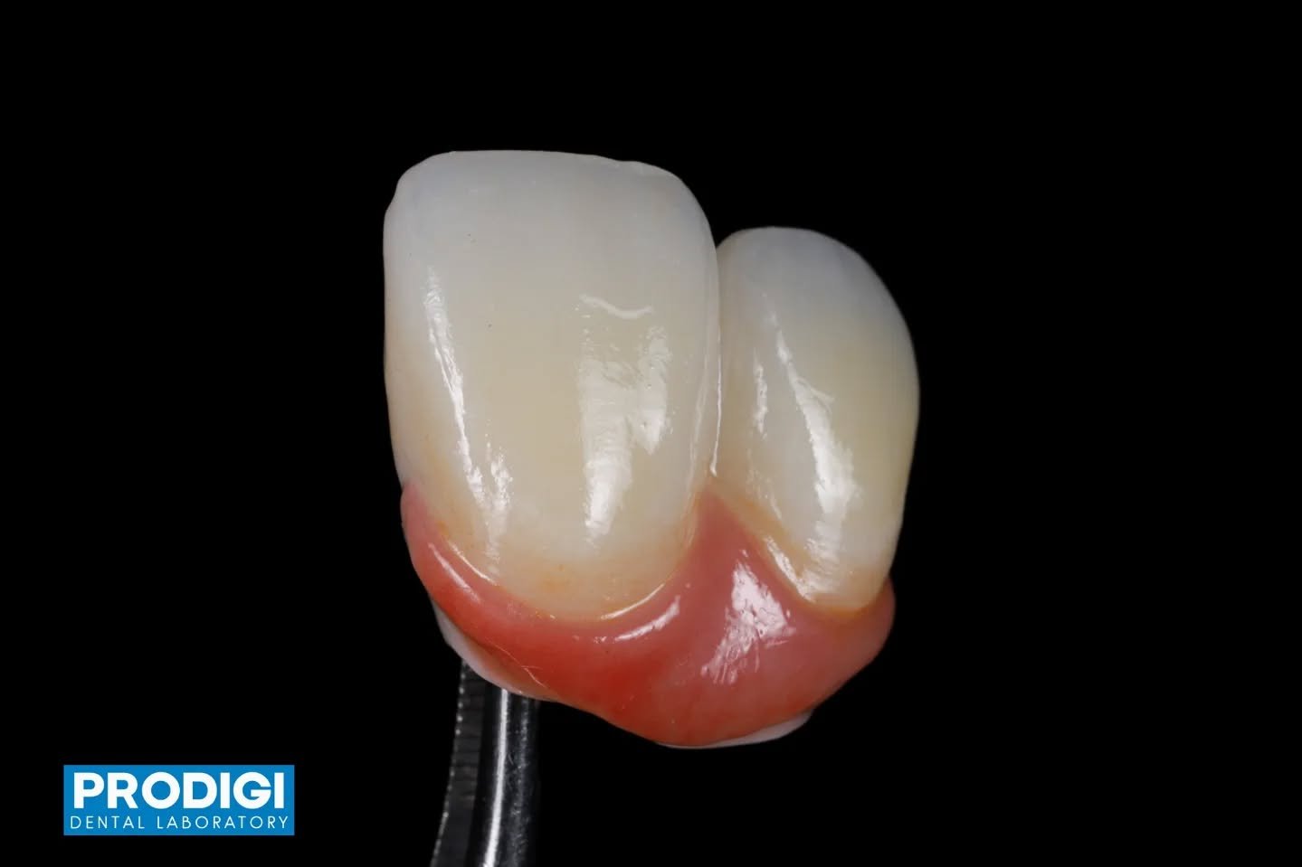 Splinted implant bridge supported by custom abutments, enhanced with gum porcelain characterization and facial porcelain buildup 🦷✨

Designed to recreate natural soft tissue contours and lifelike esthetics while maintaining strength, fit, and long-t