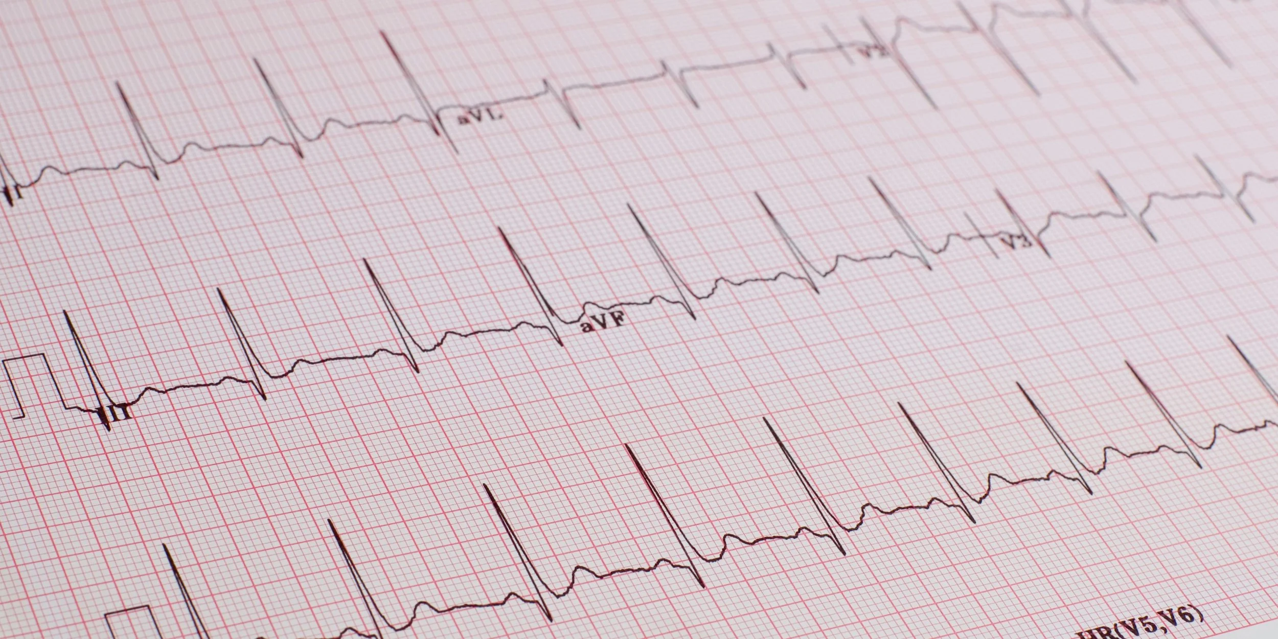Electrocardiogram (ECG) printout on grid paper with multiple waveforms and labeled leads