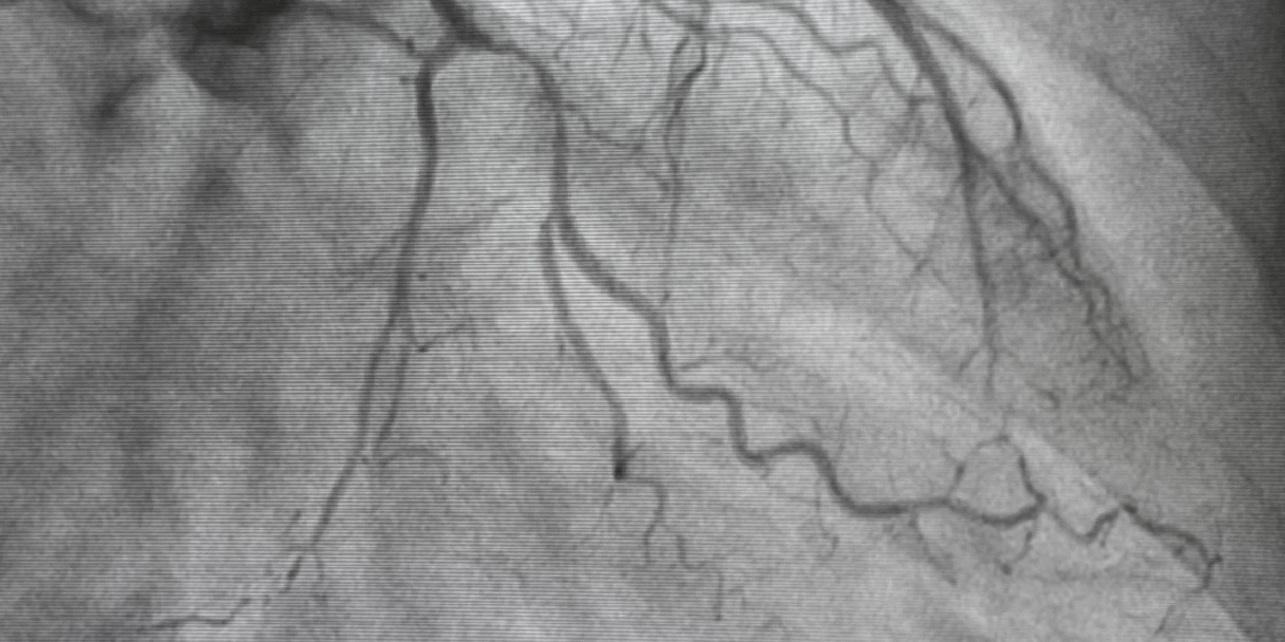 Black and white medical image of coronary arteries, showing blood vessels of the heart.
