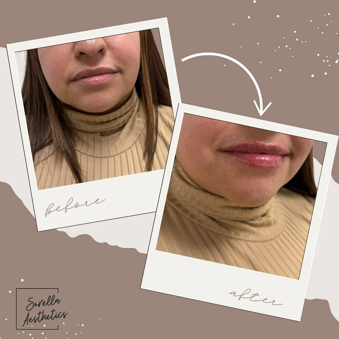A little before and after using RHA 2 ✨

The goal? To hydrate, plump, and enhance her natural shape &mdash; keeping everything soft, subtle, and oh-so-glowy 💋

#RHA2 #LipGoals #NaturalEnhancement #HydratedLips #SorellaAesthetics