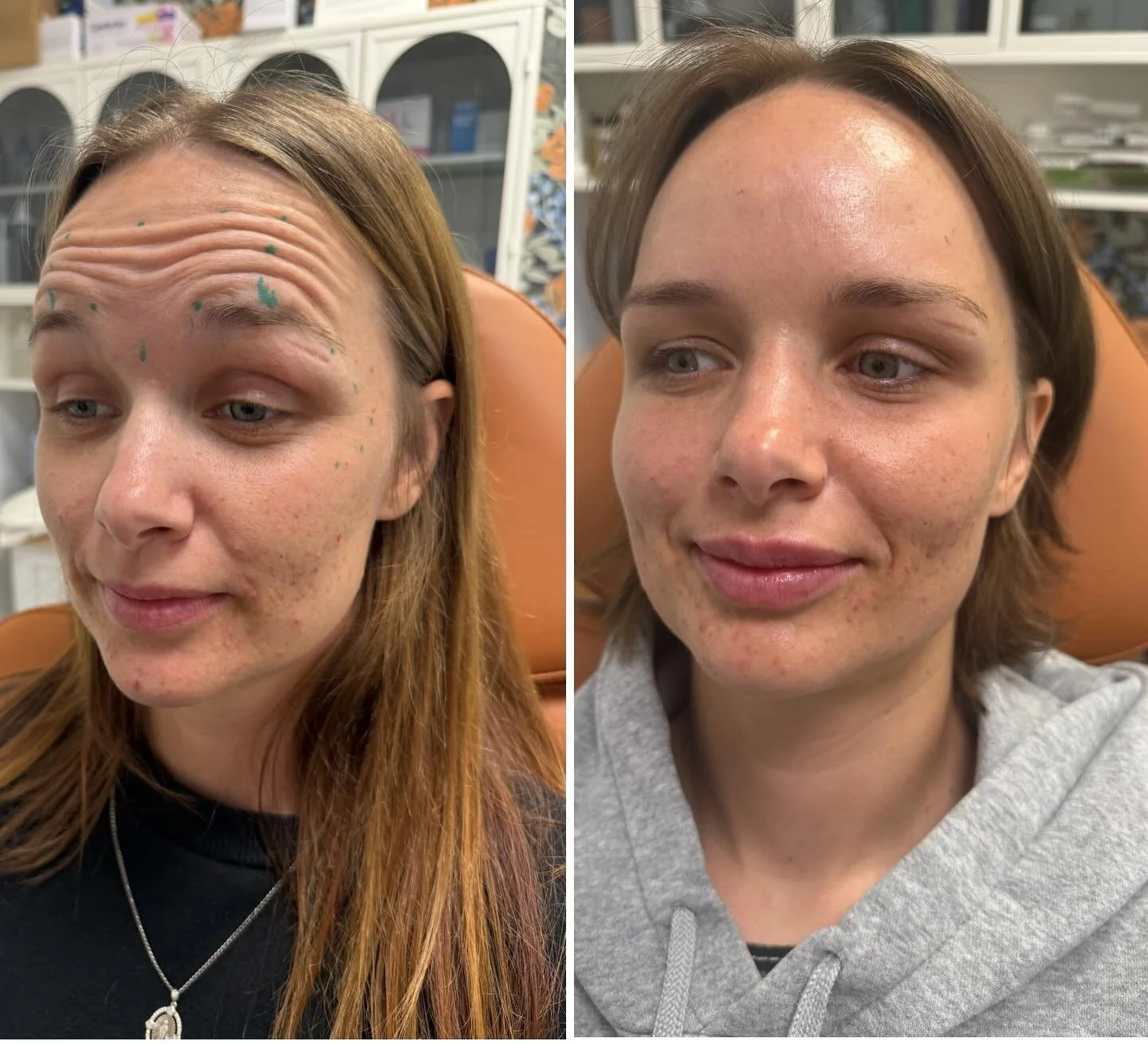 Here&rsquo;s a before &amp; after of our lovely client who received Daxxify for fine lines and a touch of lip filler for natural volume.

-The first photo is pre-treatment and the second photo is the 2 week follow up after daxxify is fully kicked it!