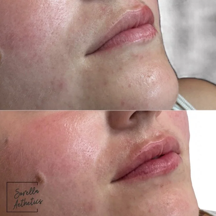 A little before and after moment 👄 

RHA 2 was used to enhance this beauty&rsquo;s lips &mdash; focusing on hydration, definition, and a naturally plump finish. Perfect for those wanting that softness without looking overdone.
⠀⠀⠀⠀⠀⠀⠀⠀⠀
✨ Hydrated
✨