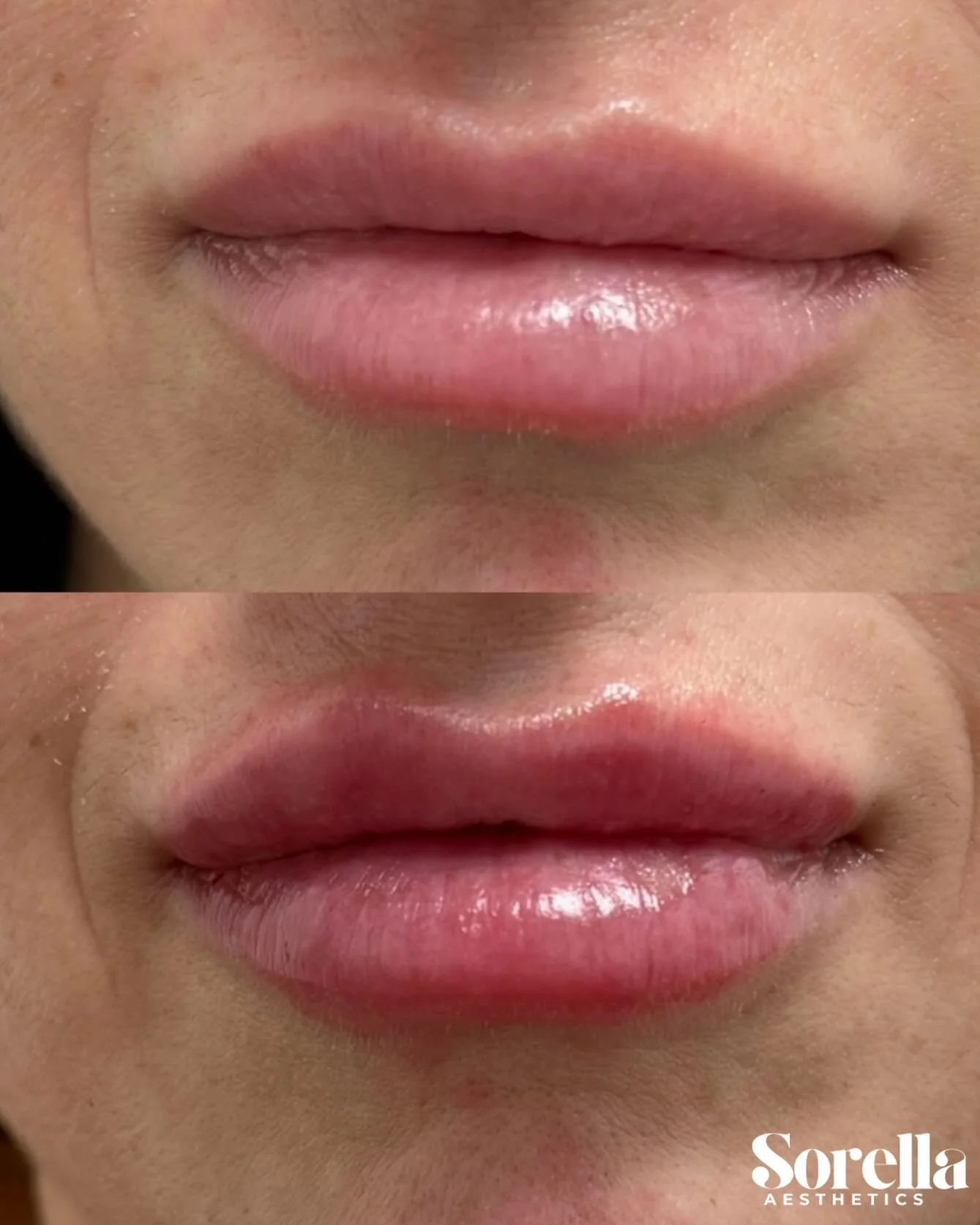 Hydrated, plumped, and naturally defined using RHA&reg; 2 for soft, flexible results.
✨ Are you looking for results like these? Book your appointment today.👄