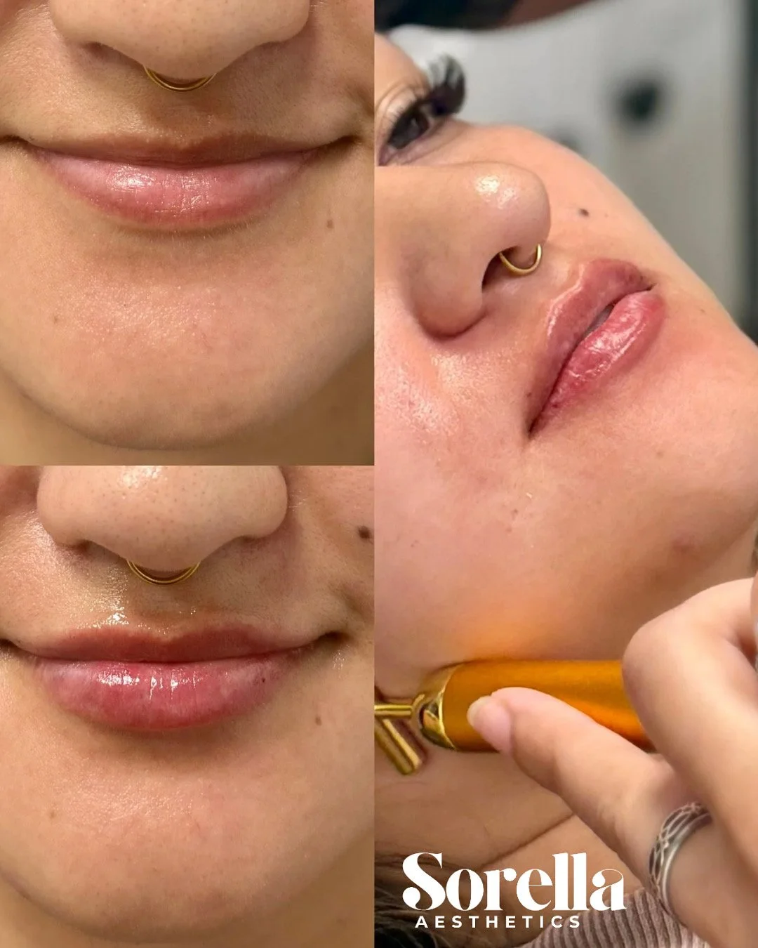 Close-up images of a woman's face showing before and after facial cosmetic procedures, including lip and skin treatments, with a logo for Sorella Aesthetics.