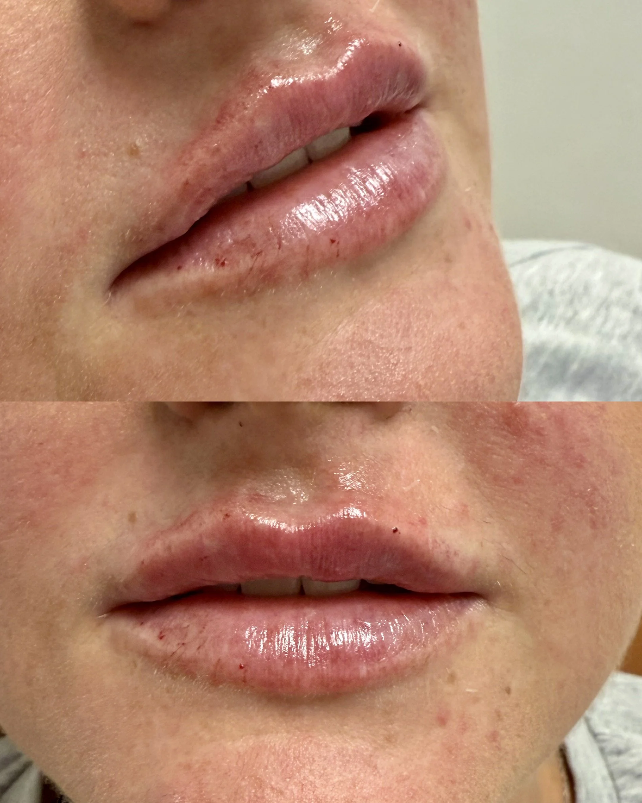 Close-up of a person's lips and surrounding facial skin, showing some redness and small blemishes.