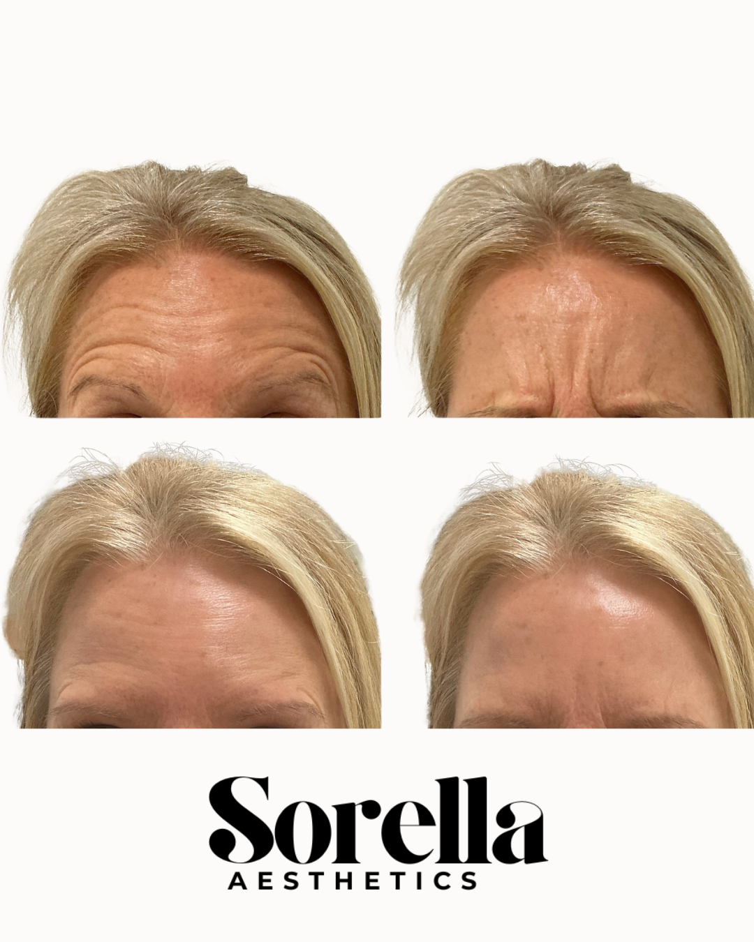 Before and after photos showing forehead wrinkles reduction following aesthetic treatment at Sorella Aesthetics.
