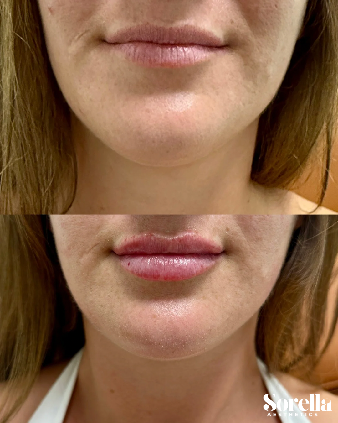 Comparison of a woman's lips before and after cosmetic lip enhancement, showing fuller lips with gloss after treatment.
