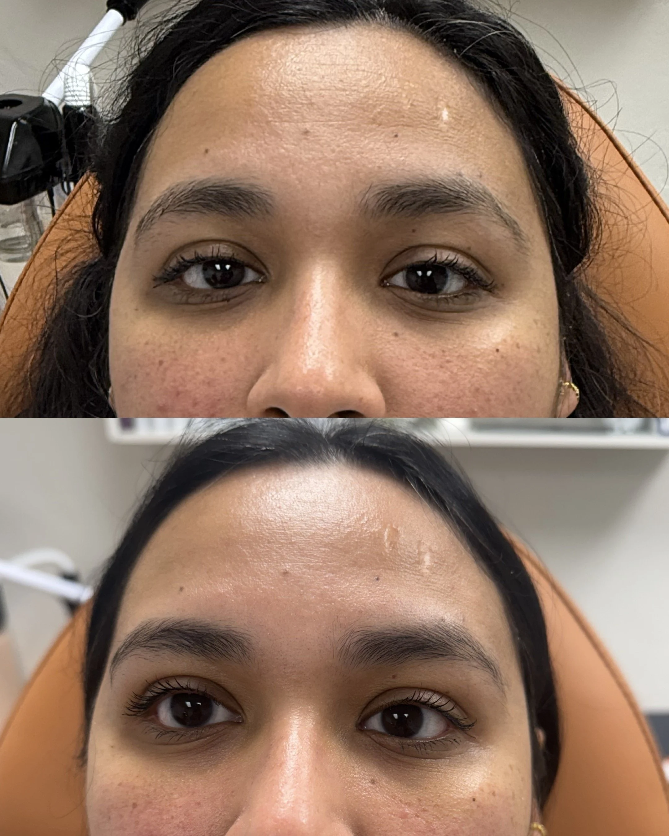 Close-up of a woman's forehead, eyes, eyebrows, and part of her nose. She is lying on an orange surface, with her hair partially visible. The background shows some medical or dental equipment.