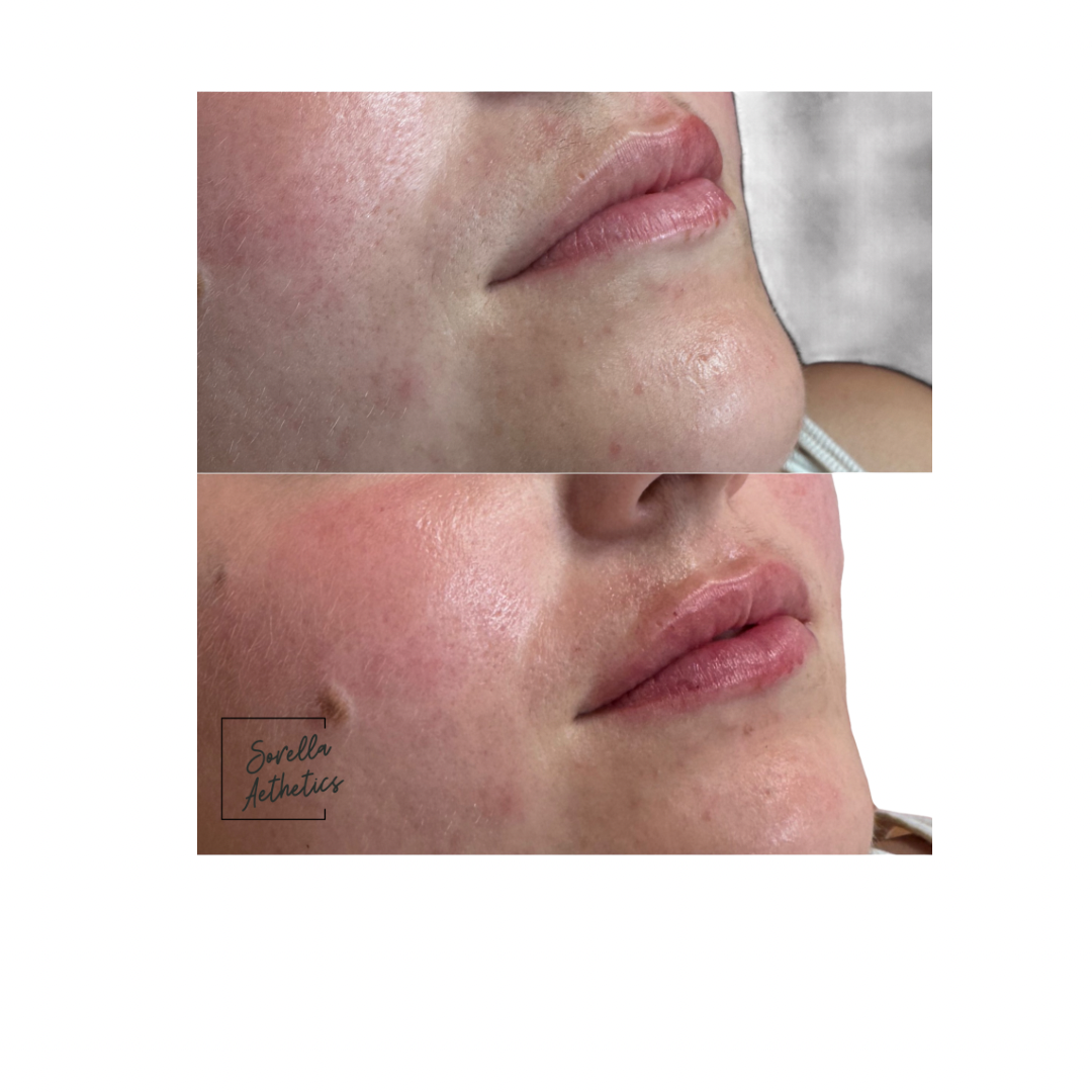 Close-up of a person's cheeks and lips showing before and after skin treatment results, with smoother and clearer skin in the after photo.
