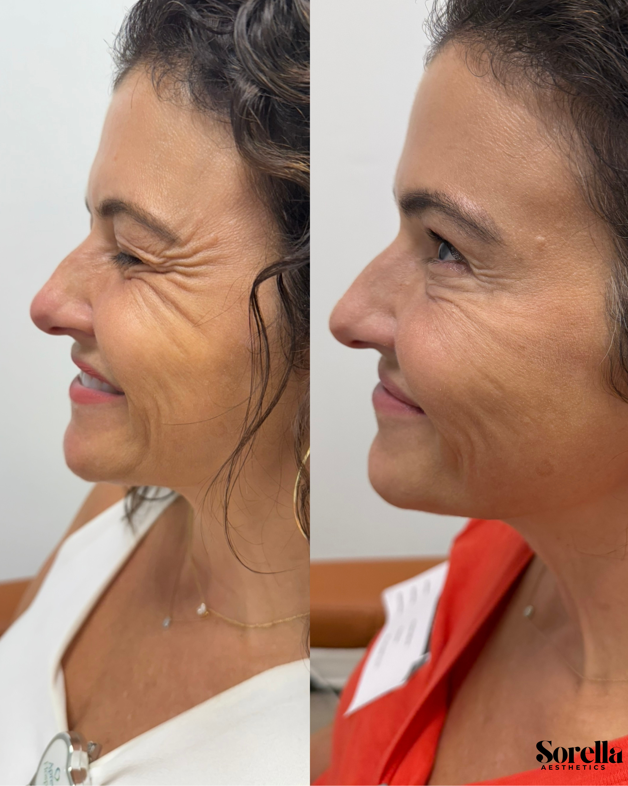 Side-by-side comparison of a woman's face before and after aesthetic treatment, showing reduction in wrinkles around the eyes and forehead.