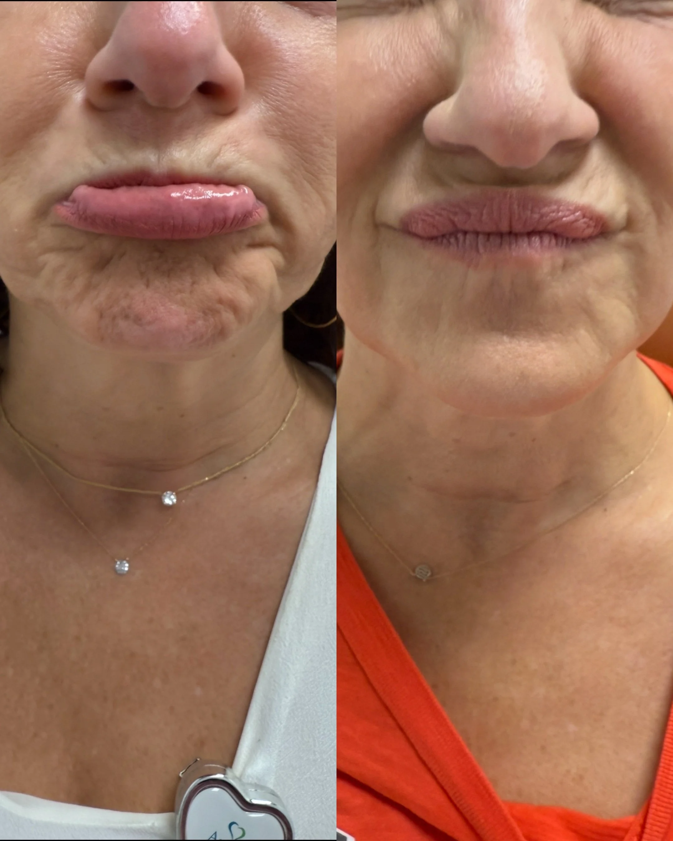 Close-up of a woman's face showing a before-and-after comparison of her lips and skin. On the left, her lips are chapped and her skin appears dry and wrinkled. On the right, her lips appear smoother and more hydrated, and her skin looks healthier. Sh