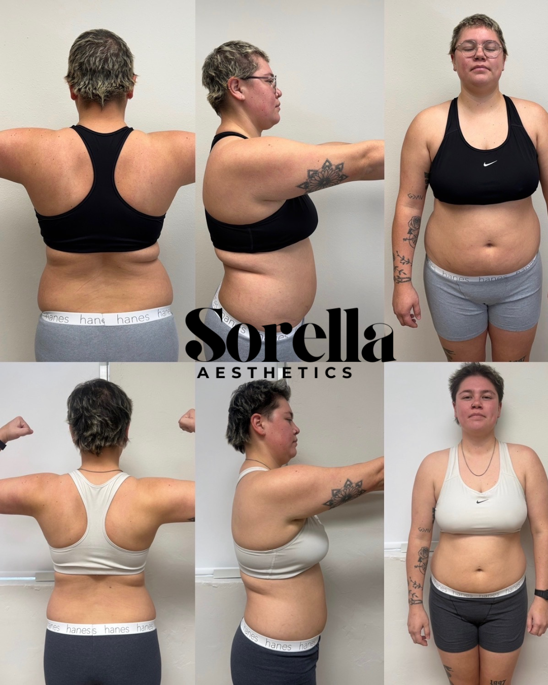 Before and after photos of a woman showing body transformation with visible weight loss on front, back, and side views, with the logo for Sorela Aesthetics.