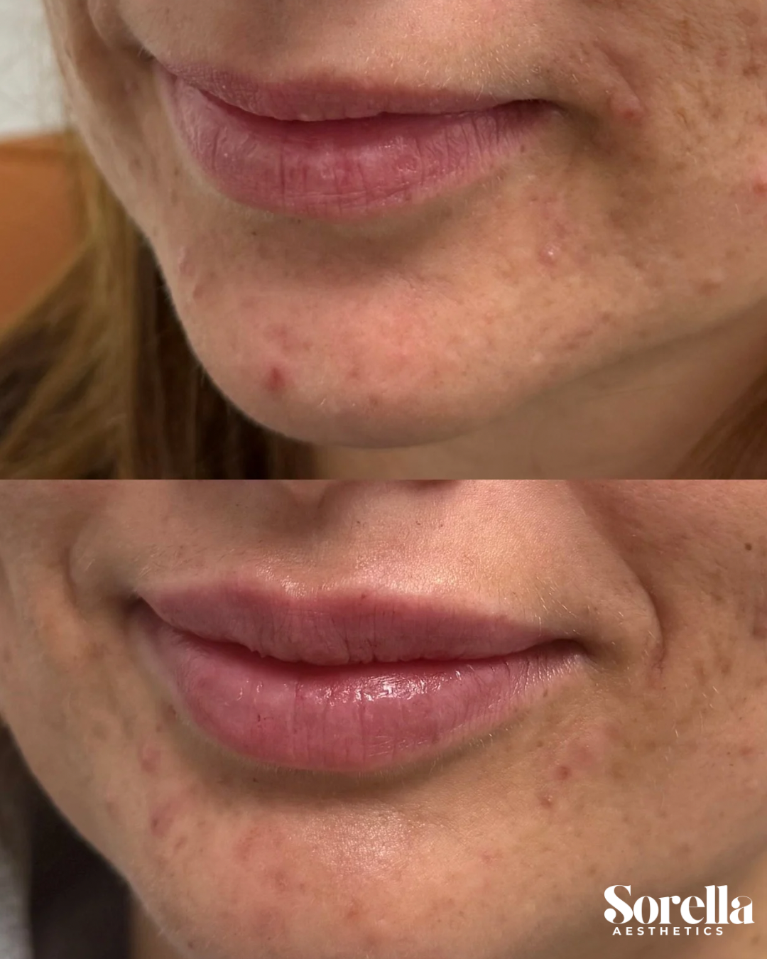 Before and after close-up images of a person's lips and chin, showing improvements in skin texture and reduction of acne or blemishes after a skincare treatment by Sorella Aesthetics.