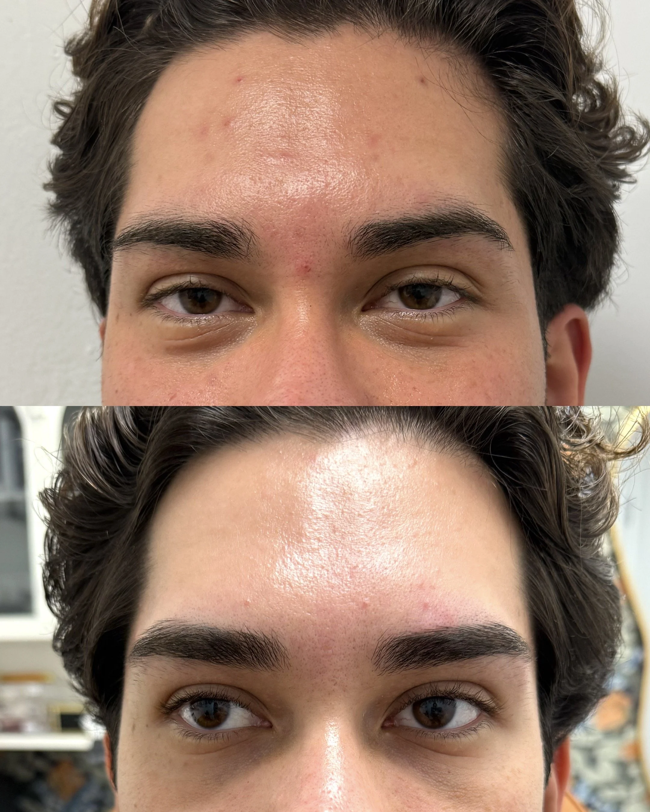 Close-up of a young person's face, focusing on the forehead and eyes, with visible skin with some blemishes, and dark eyebrows.