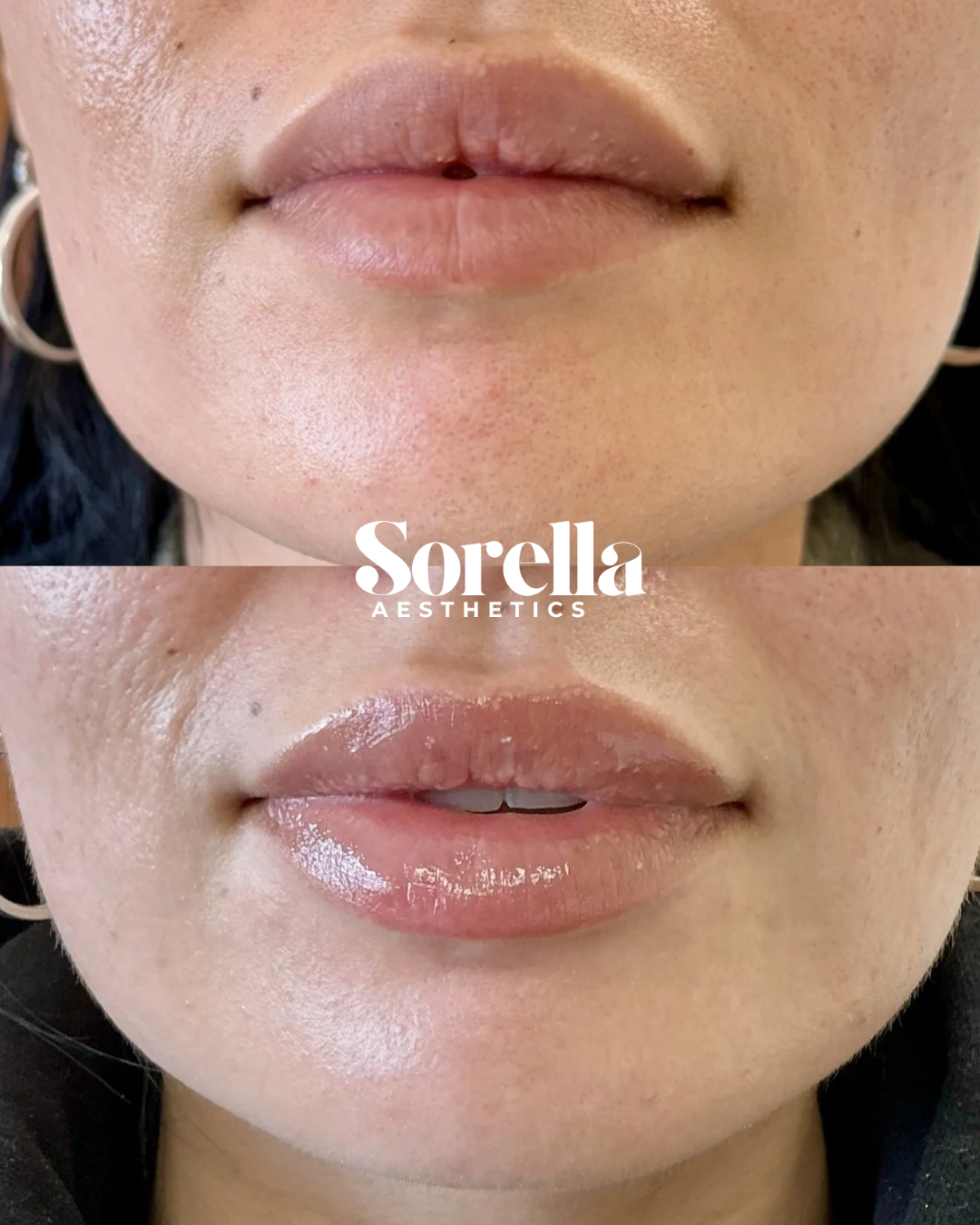 Close-up of a woman's lips before and after receiving cosmetic lip treatment, showing smoother, fuller lips in the after image.