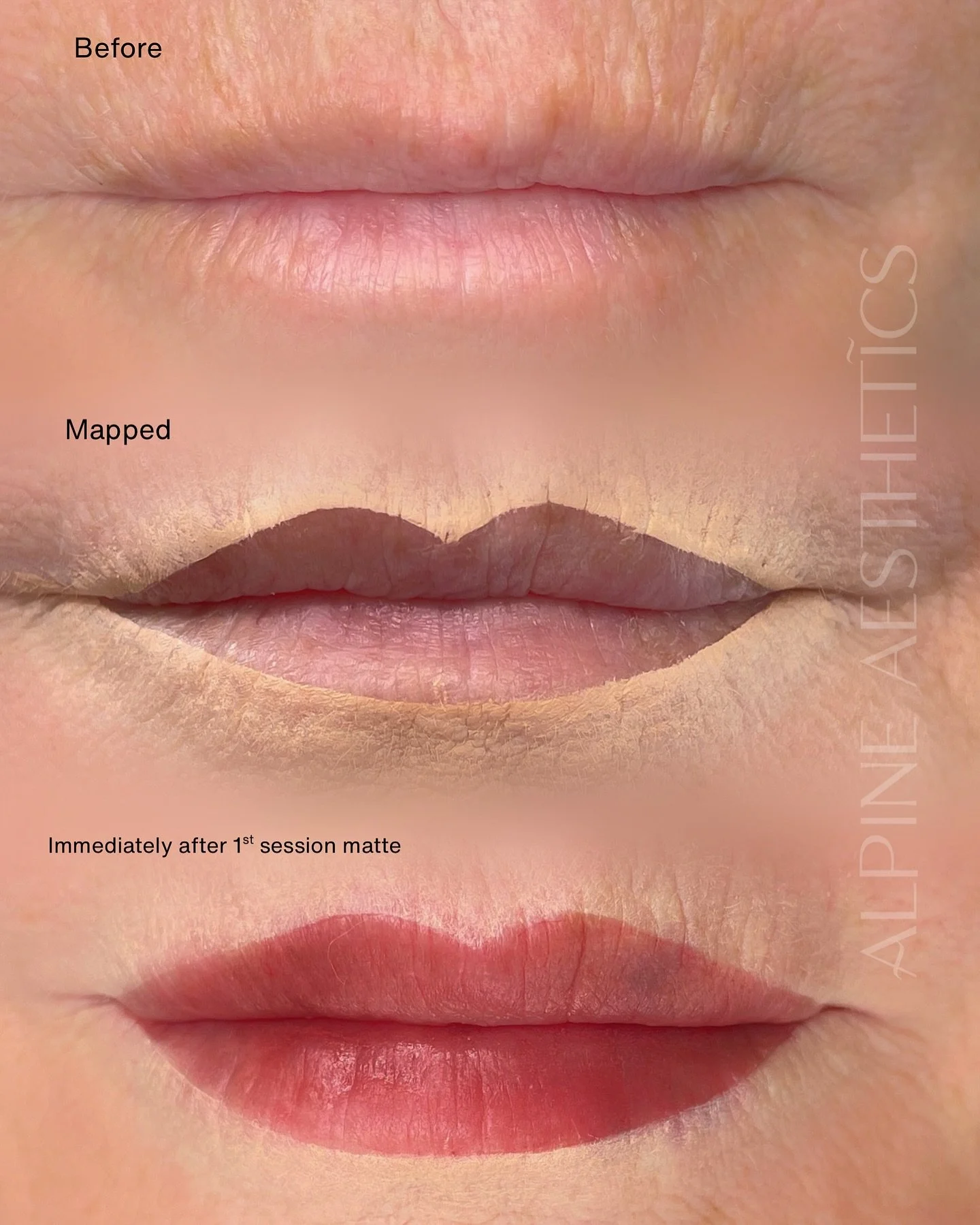 MATURE LIPS | LIP BLUSH 💋
My lovely client came to me with mature lips — sun damage, scarring, and no defined border — and a clear vision: she really wanted a Cupid’s bow again and to look done. We also talked about removal for her