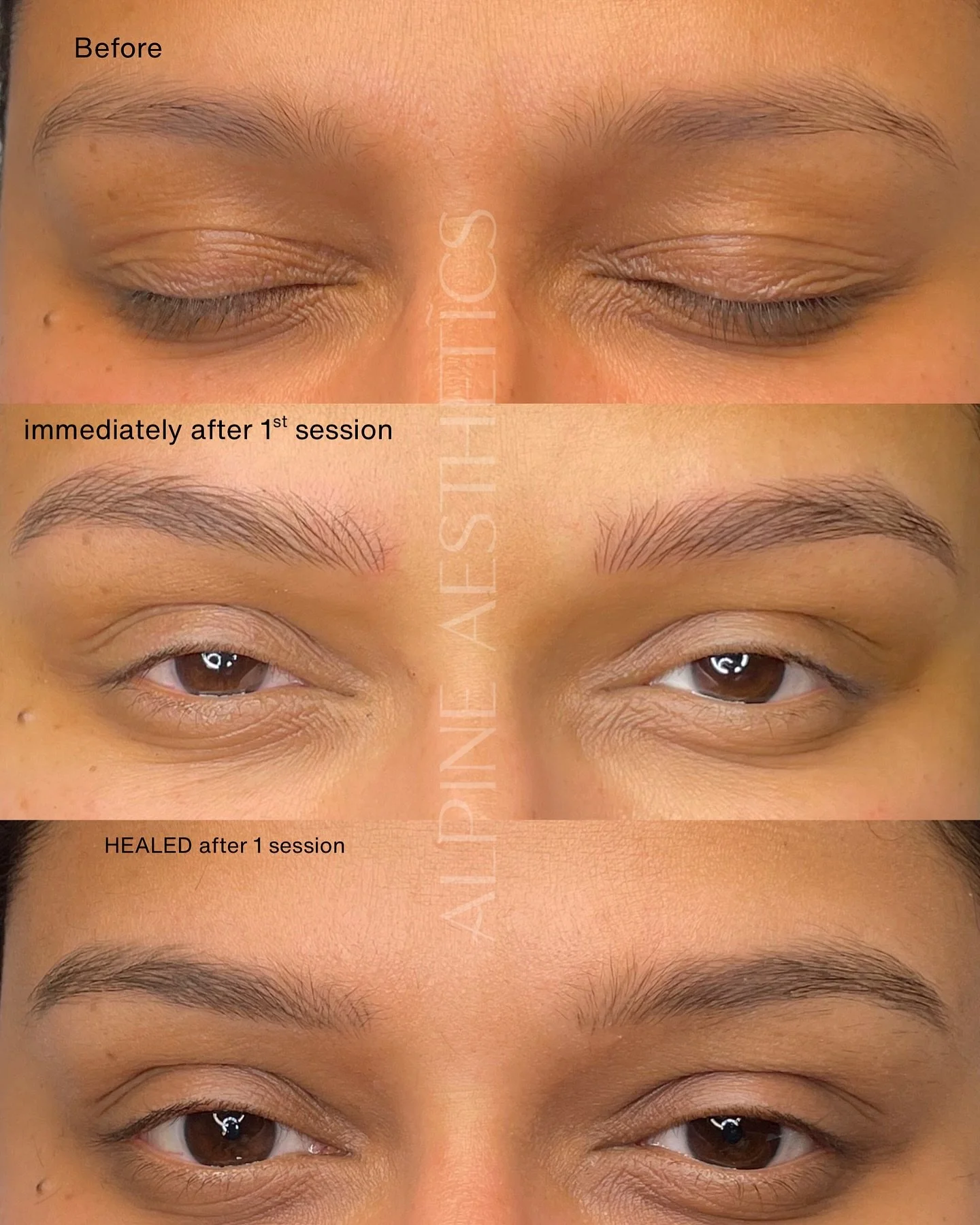 NANO – Before & After (Healed after 1st session)
Absolutely in love with nano brows. These are the softest, most natural-looking brows you can get and still, look at the difference they make!
This is one of those beauty trends that’