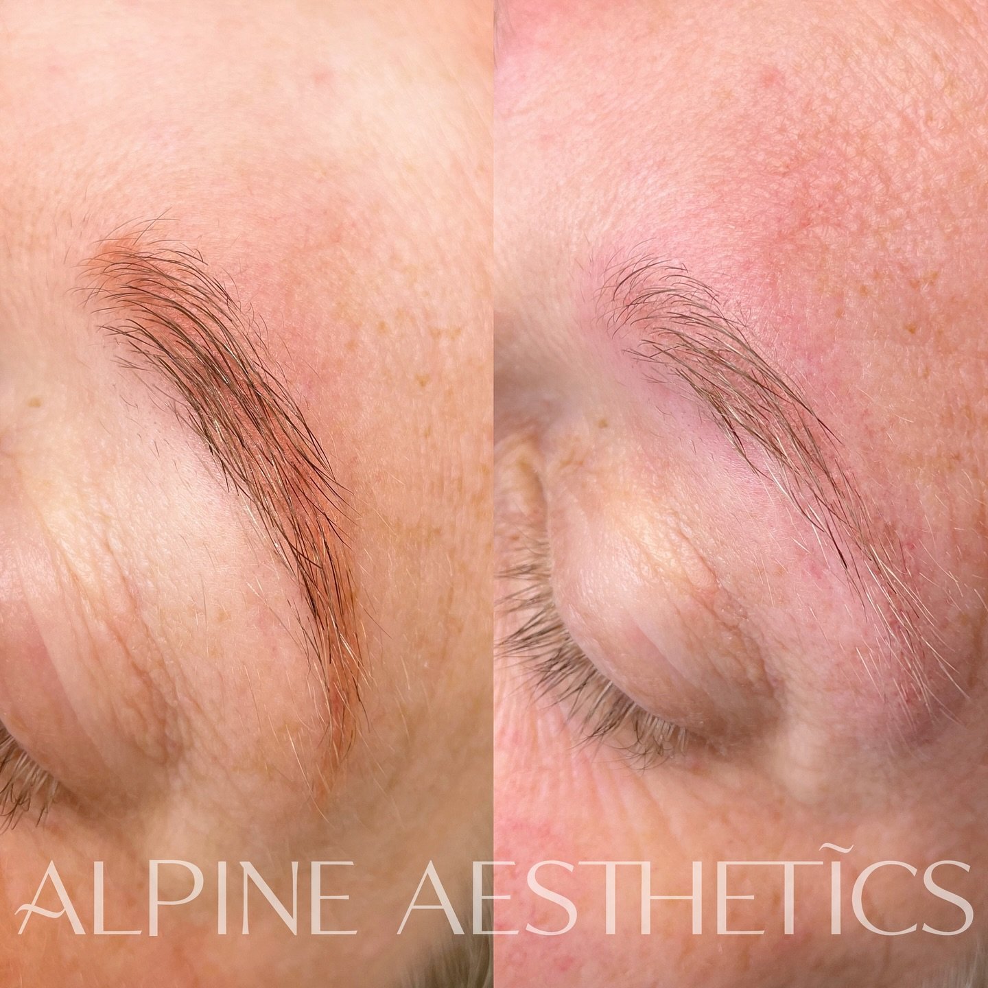 - REMOVAL -
At Alpine Aesthetics, we take every aspect of your cosmetic tattoo seriously especially when it comes to colour correction and removal. Understanding the right approach for your skin and long-term brow goals is essential for achieving sof