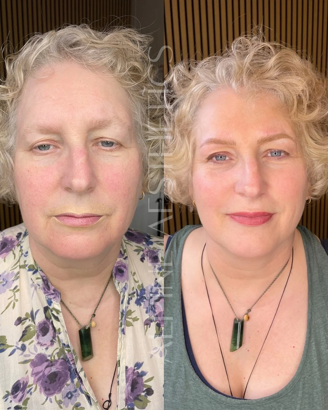 - Mama - my mummy. 

A little story for you about my mama. when my mum was about 17, a family friends dog attacked her face and she needed to have 50 stitches all over her face. (The surgeons did an incredible job and you can hardly see any scars), h