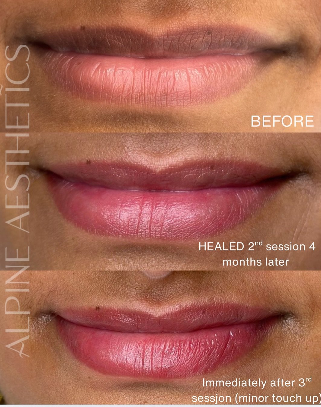 - LIP BEUTRALISATION -
It was an absolute pleasure getting these beautiful lips across the finishing line today! Thank you @divs.george for trusting the time and process to get these perfect for you. Your journey started in November and the process w