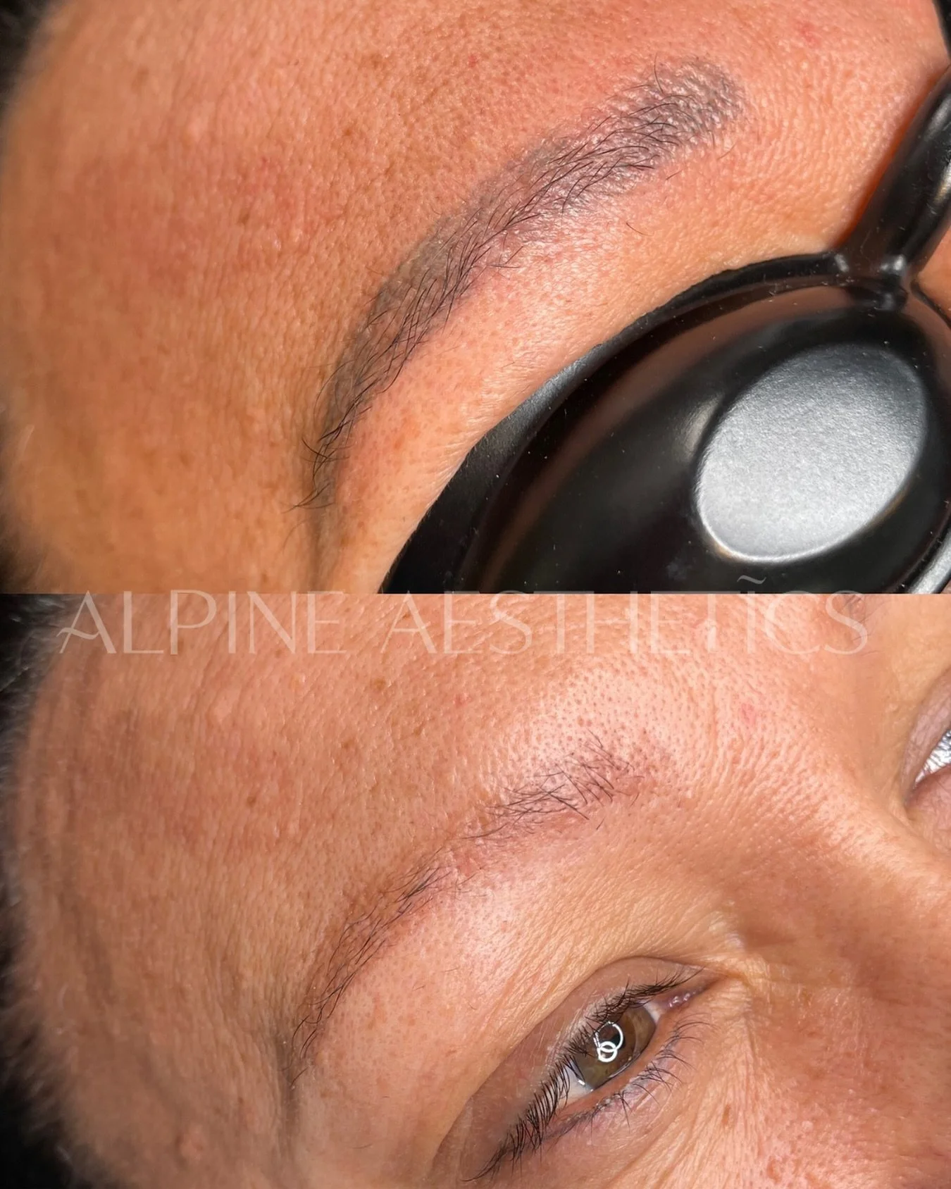 - TATTOO REMOVAL - 3 weeks healed 
after my specialised PMU removal system. After just 1 session my beautiful client is ready to have her new brows with me😍! 

This is by far the best outcome- but there are so many variables involved as to how long 