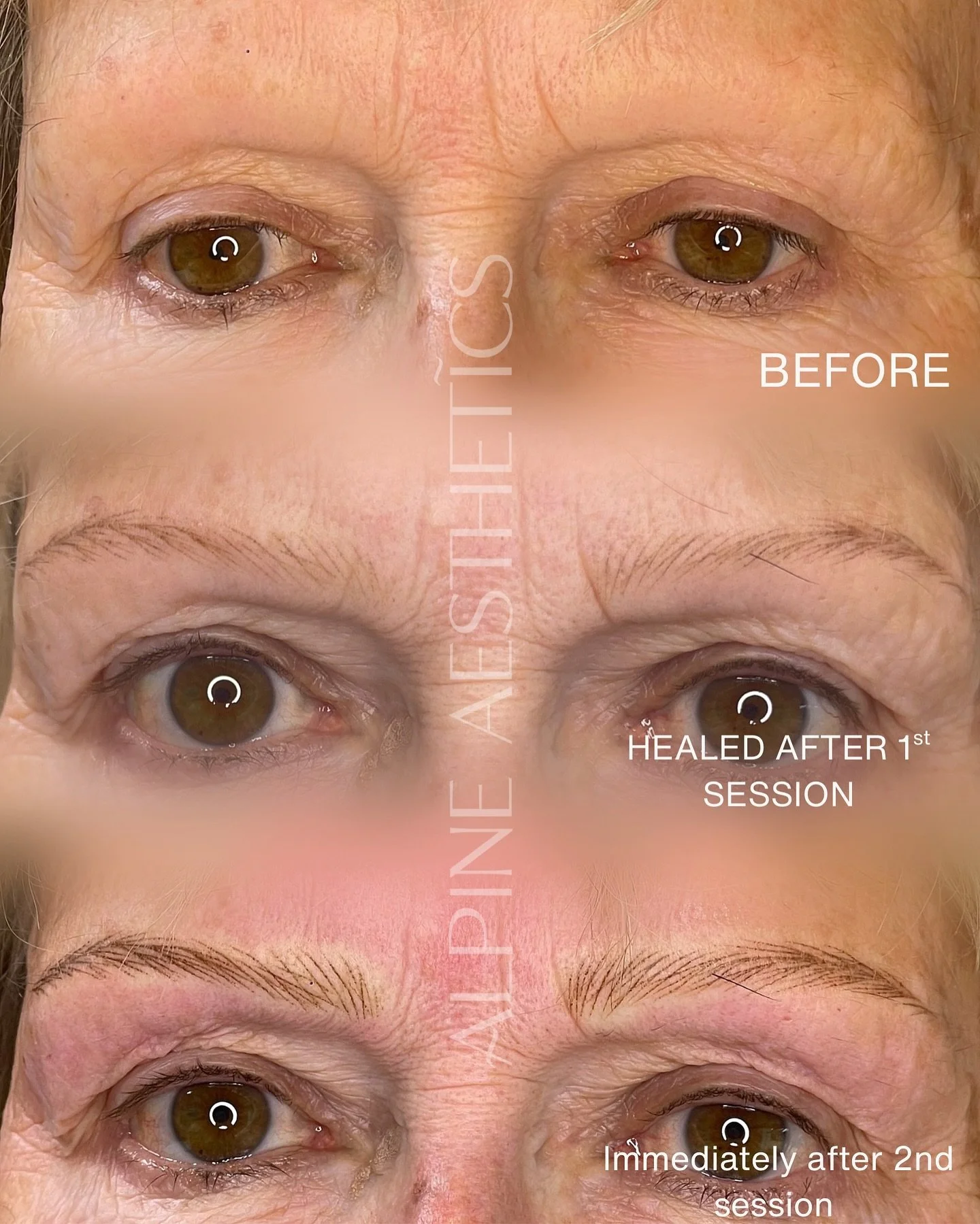 - HEALED NANO - 🥹🥹
Remember this beautiful soul? She came to me with progressive frontal alopecia, so nervous and not confident. 
Well fast forward 6 weeks post her first session, and I am so THRILLED with how these healed. She was beaming, and sai