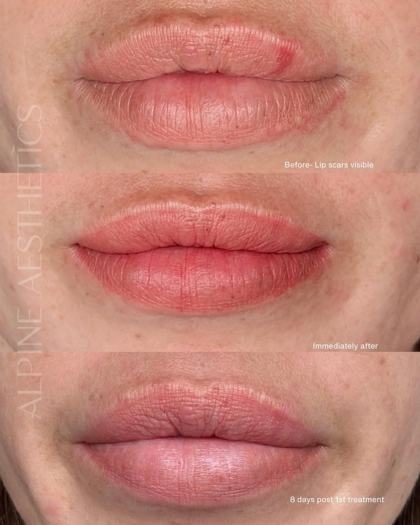 - SHEER LIP BLUSH-  HEALED 1st Treatment. 
but let&rsquo;s talk a moment about a couple of things, sometimes it&rsquo;s more than just &ldquo;I want lip colour&rdquo;. Sometimes it&rsquo;s about camouflaging and correcting. 

And for this beautiful c