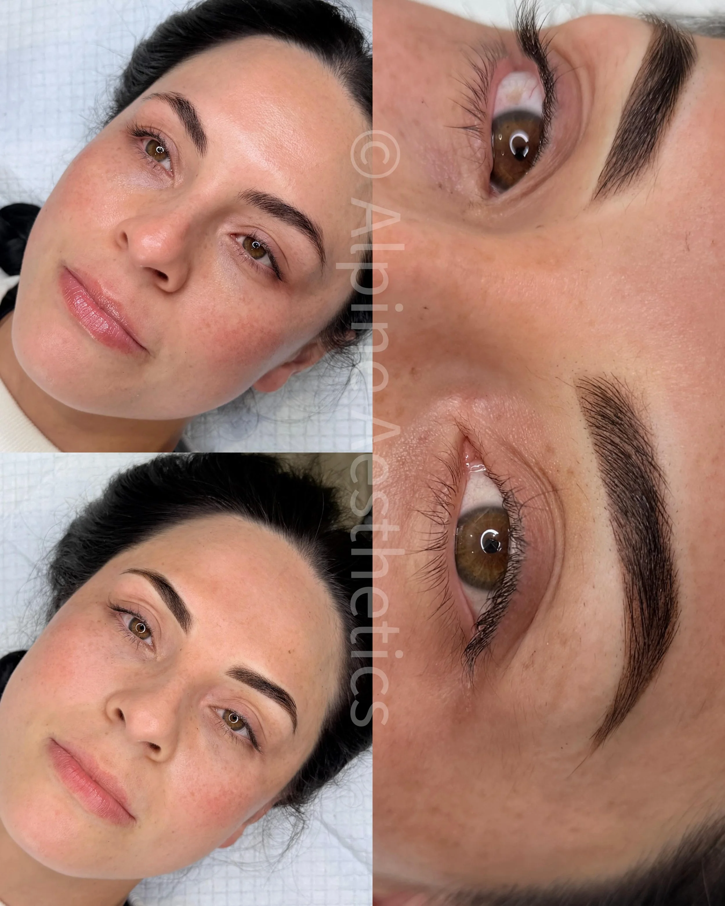 - OMBR&Eacute; -
These. Are. Everything.

Amy first came to see me back in January for removal of her previous brow tattoo. There was residual iron oxide red and some darker chromium oxide black pigment remaining in the skin, so we did one PMU remova