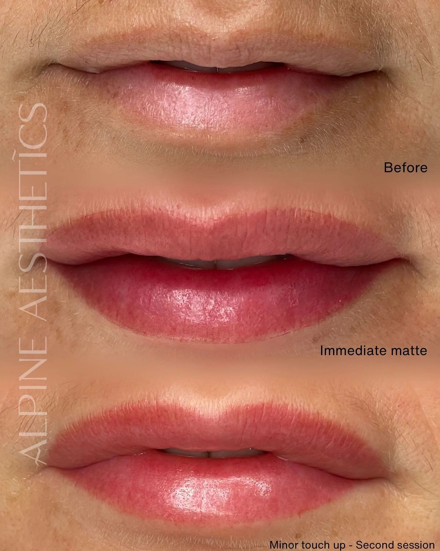 -LIP BLUSH -
Imagine waking up every morning with lips that already look fresh, healthy, and beautifully tinted. no lipstick, no liner, no effort.

These gorgeous lips were naturally well-shaped, but lacked even colour and had some pigmentation aroun