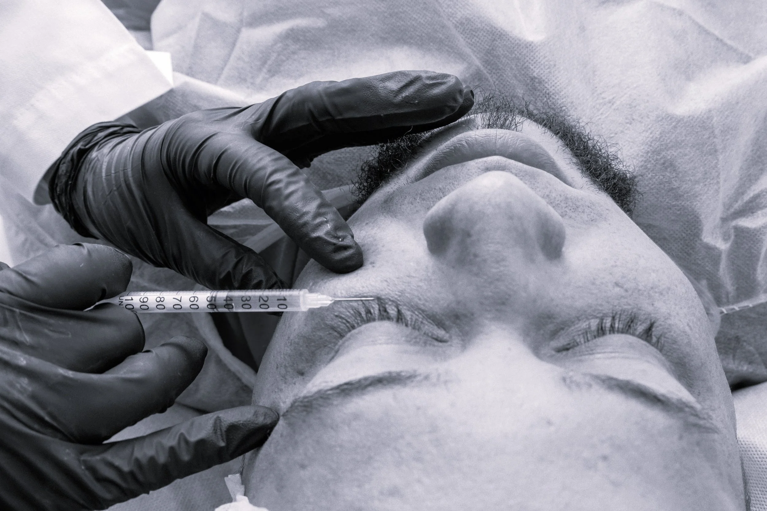 Why Are Dermal Fillers Under Eyes the Best Non-Surgical Refresh in Halifax, Canada?