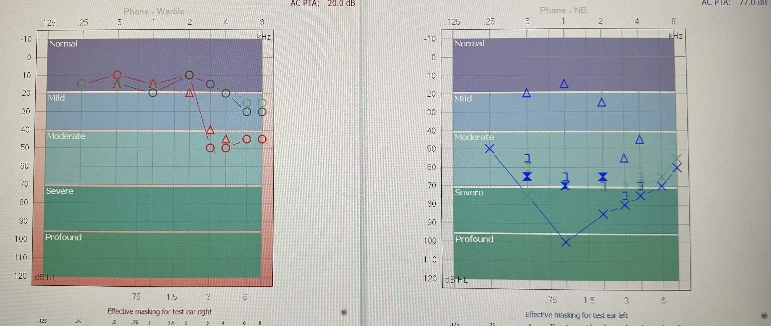 One of my audiograms. The left panel is my right ear: the black line shows my hearing level the previous year and the red line the sudden drop in September 2026. The right panel is my profoundly deaf left ear.
