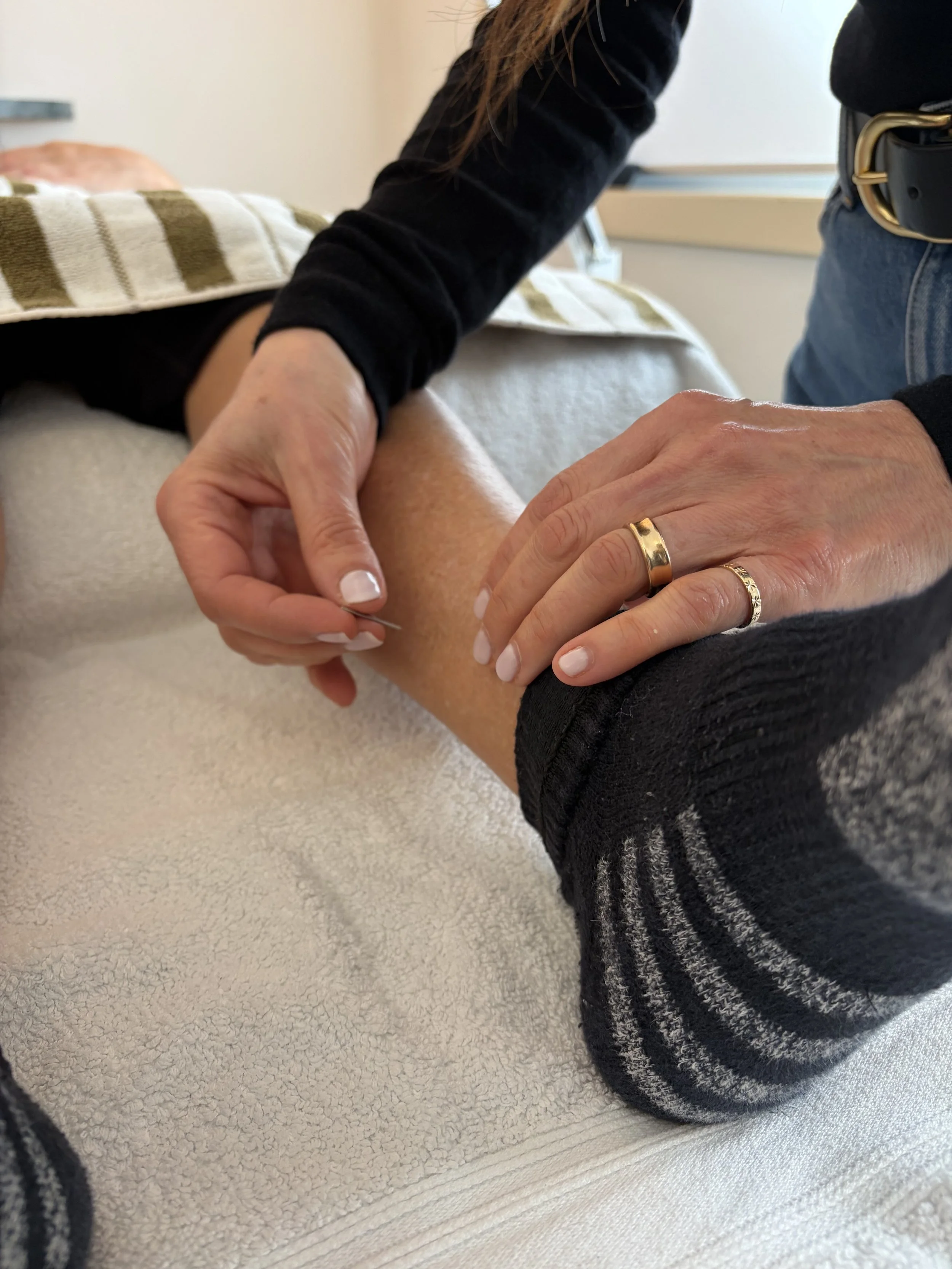 Acupuncture at MACHI Health supporting symptoms of endometriosis, pain and fertility