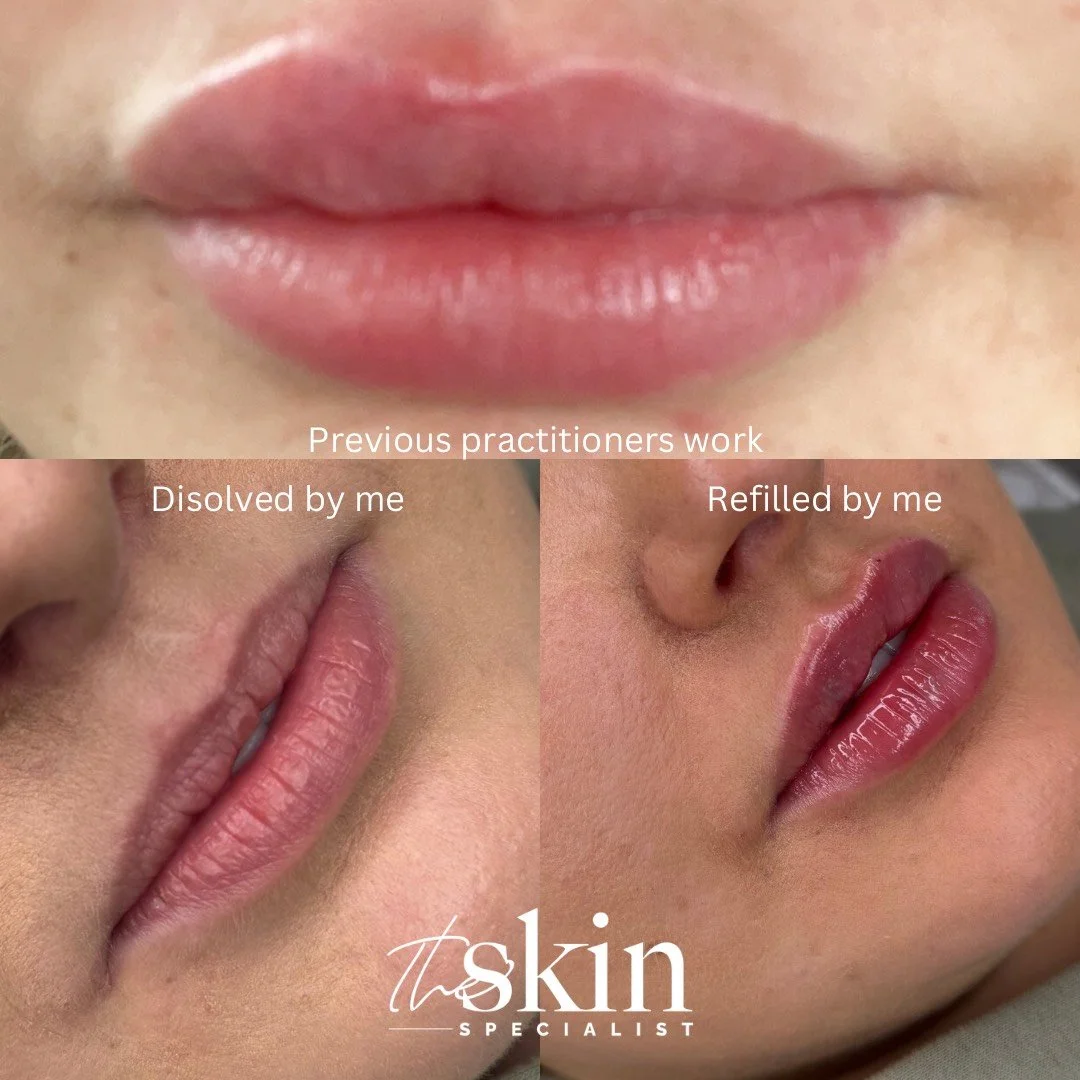 Poorly filled lips (1).png