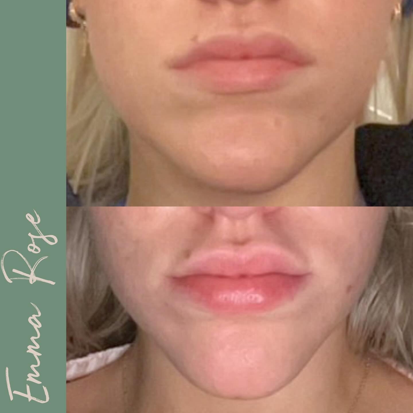 Jaw Slimming &lsquo;tox 😍 
Using Botox in the Masseter to reduce teeth grinding and slim the jawline 🥰

🤍 Emma Rose Aesthetics &amp; Laser Clinic 
🌿 Advanced Aesthetics Practitioner
🤍 Laser Technician
🌿 Home Based Clinic, Bristol
🤍 8 Years Ind