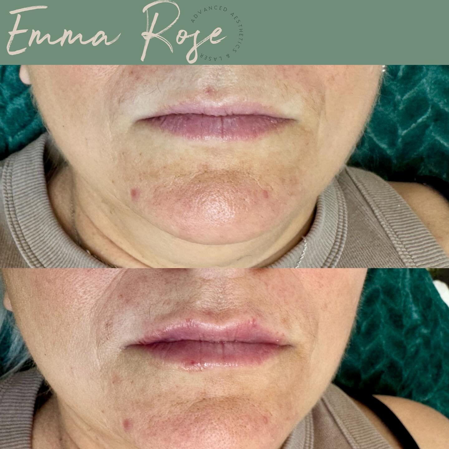 0.5ml first time filler for this lovely lady today 💉👄 
A natural result which we can build upon in future sessions 🙌🏼

 Emma Rose Aesthetics &amp; Laser Clinic 
🌿 Advanced Aesthetics Practitioner
🤍 Laser Technician
🌿 Home Based Clinic, Bristol