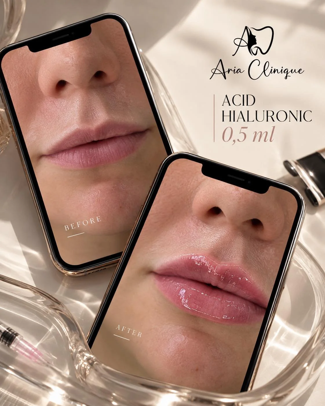 0,5 ml. O schimbare subtilă, un rezultat care păstrează naturalețea. ✨

Augmentarea buzelor cu acid hialuronic nu trebuie să &icirc;nsemne o transformare evidentă. Uneori, diferența stă &icirc;n detalii: un contur mai bine definit, un plus discret de