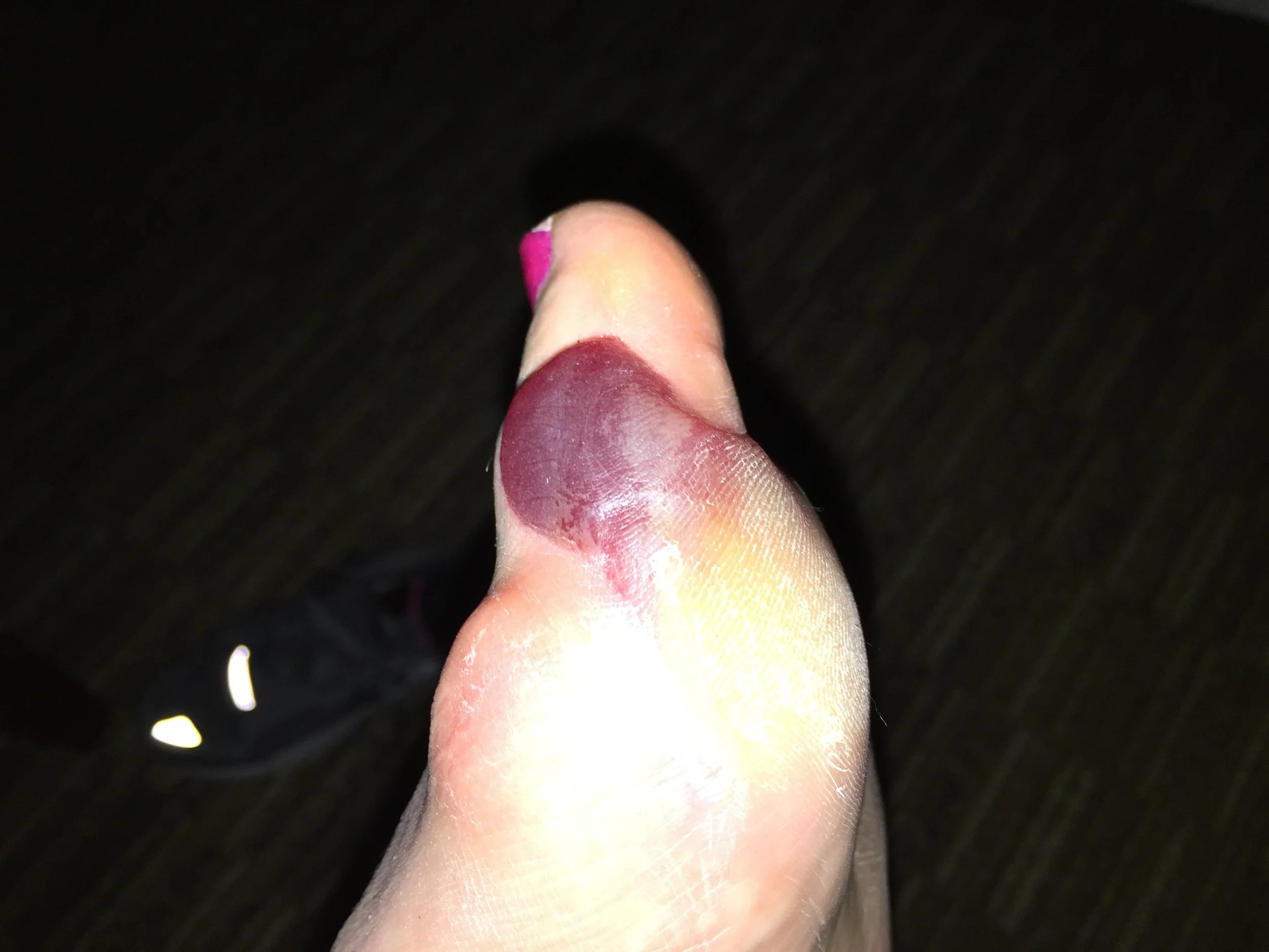 My feet told another story.  Walking 39 miles is one thing, balance challenges present another more visceral obstacle. 