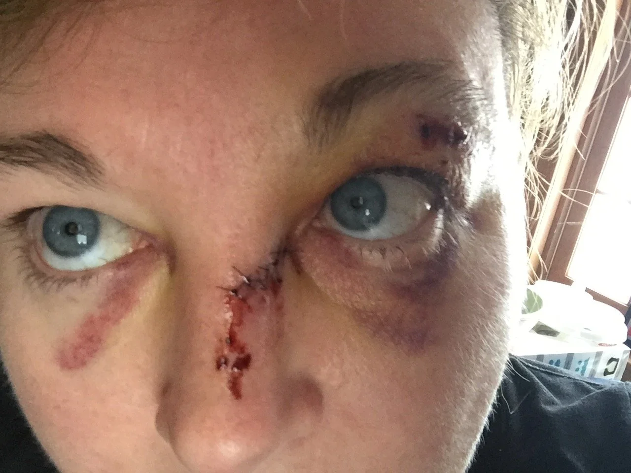 7 stitches, two black eyes and four broken ribs.  This is my most embarrassing picture.  There were many falls.  This is one.  Healing is messy, but oh, so sweet.   