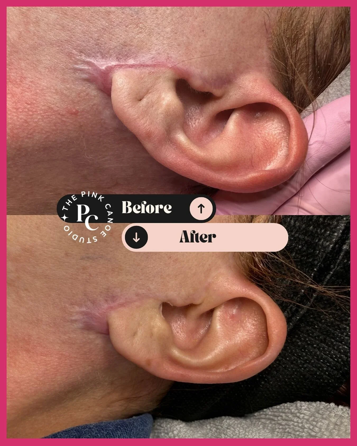 SkinPen is the GOAT when it comes to treating scars🙌🏼
Hypertrophic scars form when the body produces too much collagen as it heals, creating raised, firm areas that stay within the original wound site.
🧠 But here&rsquo;s the key: hypertrophic scar