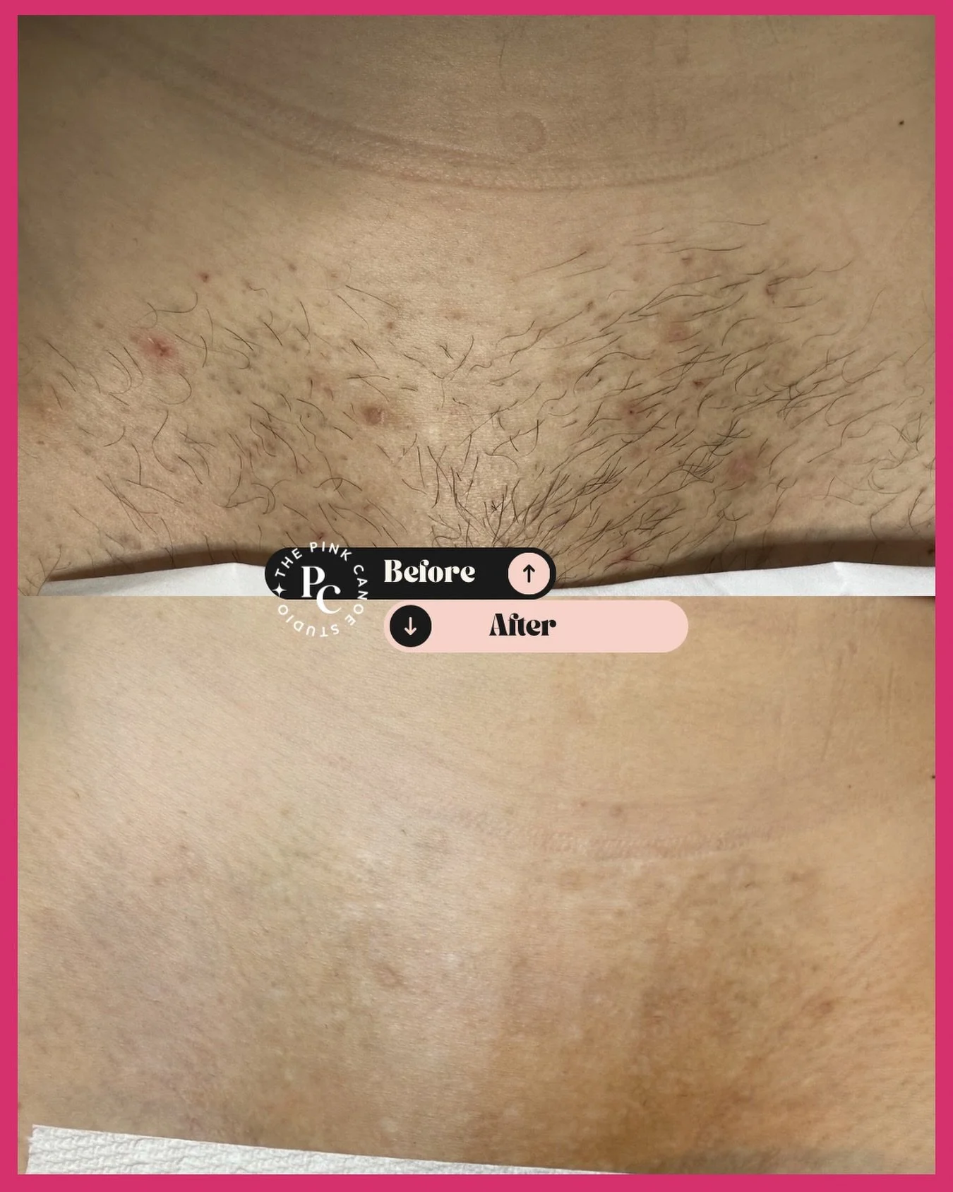 ✨ This is why we LOVE laser hair removal. 6 sessions. Zero hair. Zero ingrowns. Zero pigmentation. Just smooth, flawless skin. 🙌

This client came to us dealing with ingrown hairs and pigmentation from waxing&hellip;and look at her now. Laser hair r