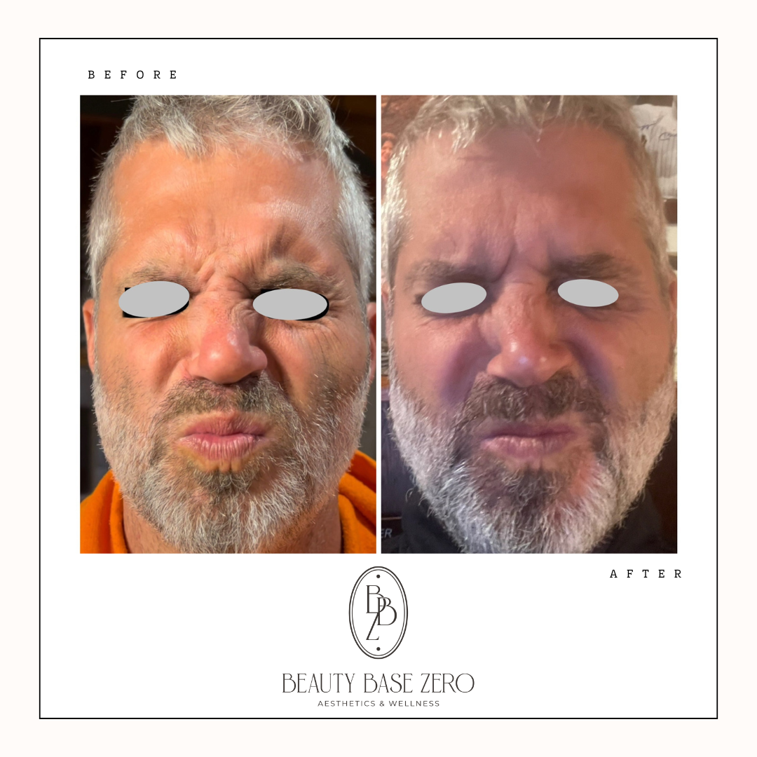 Upper face tox (1).png