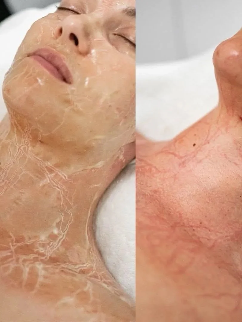 Close-up of a person's face and neck before and after using a skincare treatment, showing reduced redness and dryness.
