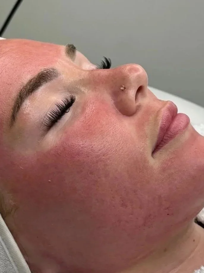 Close-up of a woman with makeup, closed eyes, and a nose piercing, lying down with red, flushed skin on her face.