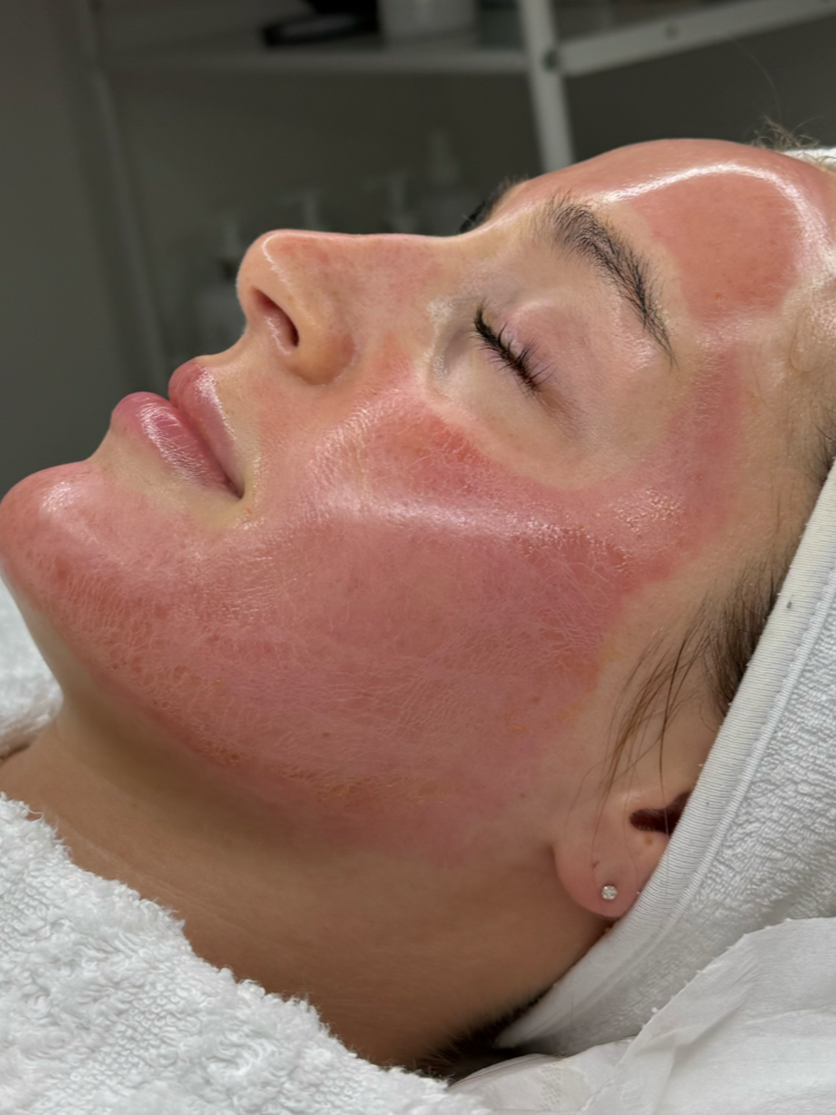 Close-up of a woman's face during a skincare treatment, with redness and some peeling or irritation visible on her cheek and forehead.