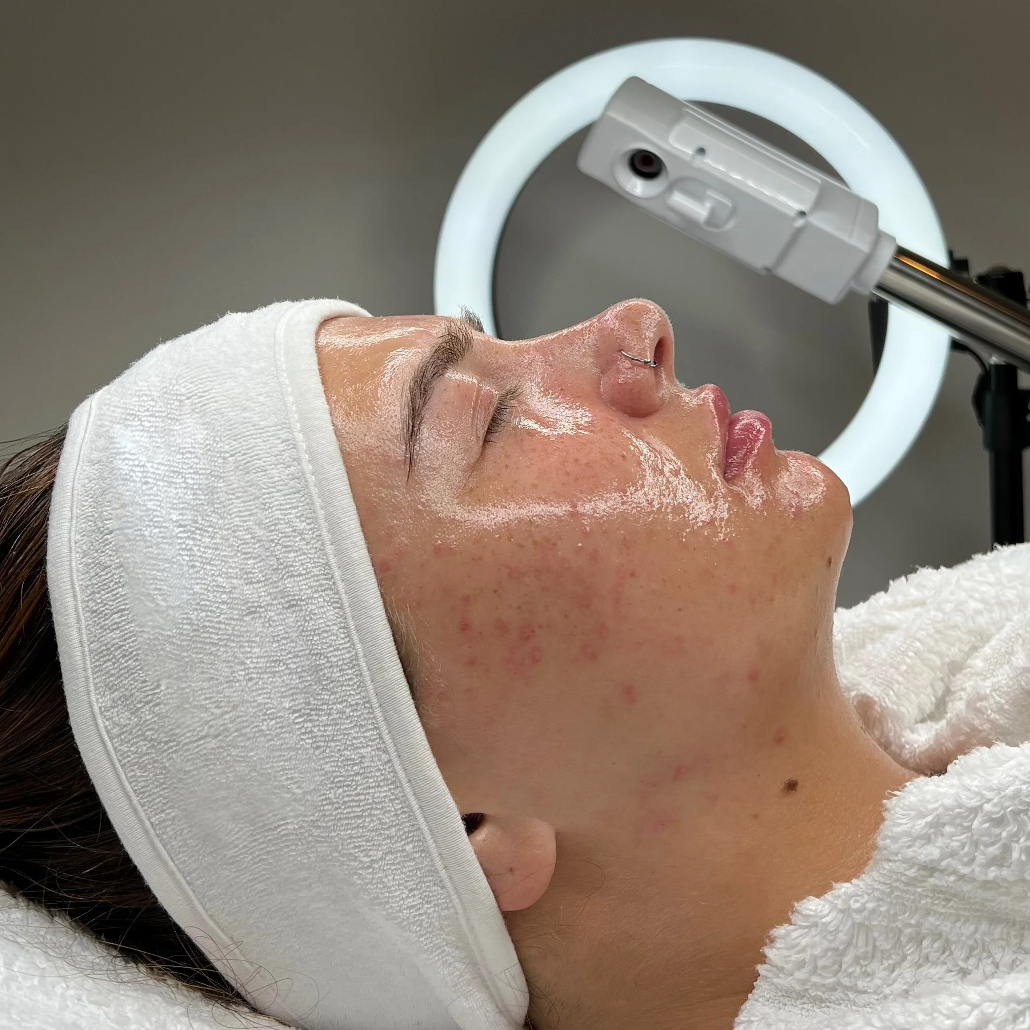 Dermaplaning