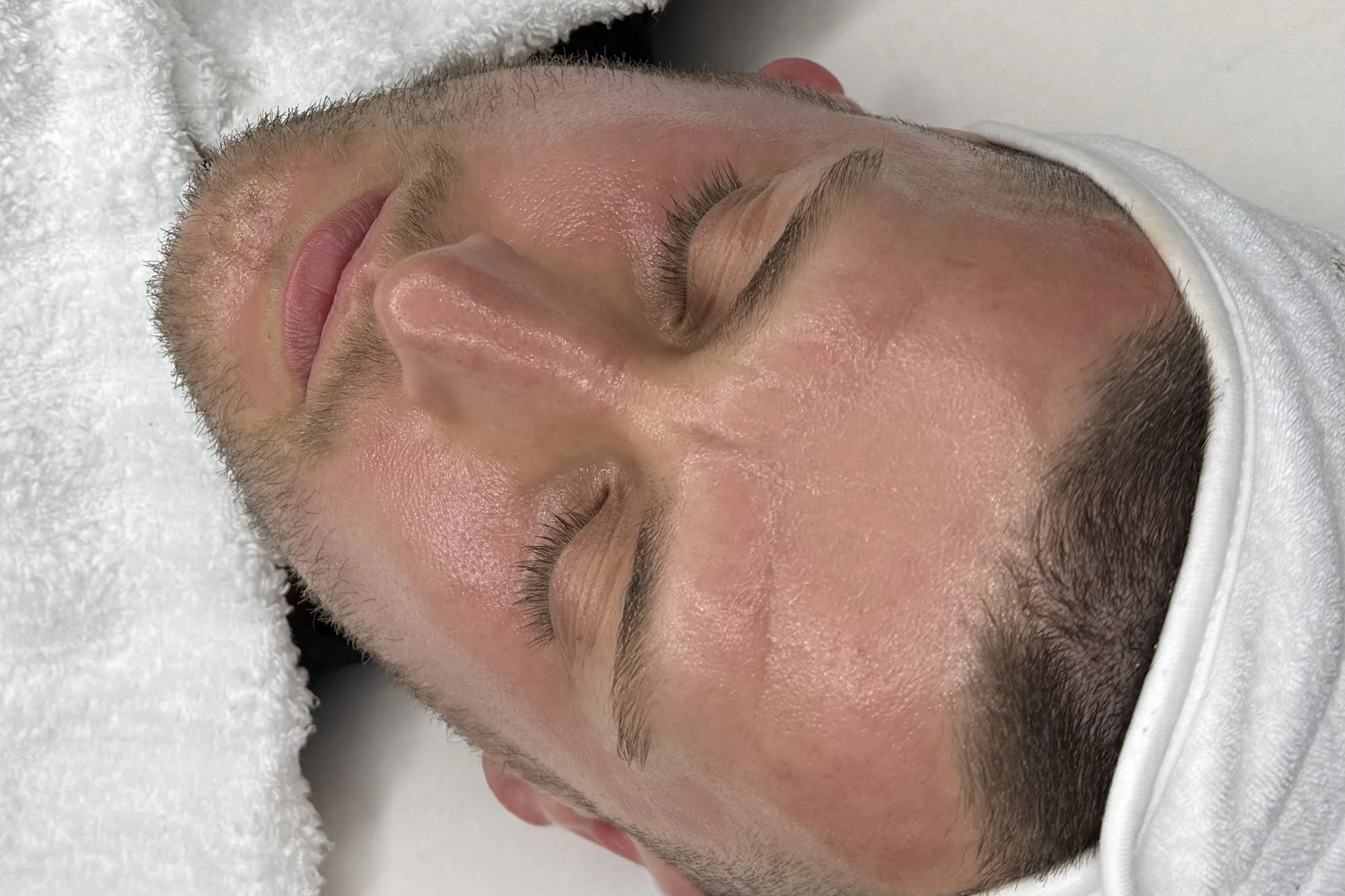 Microneedling