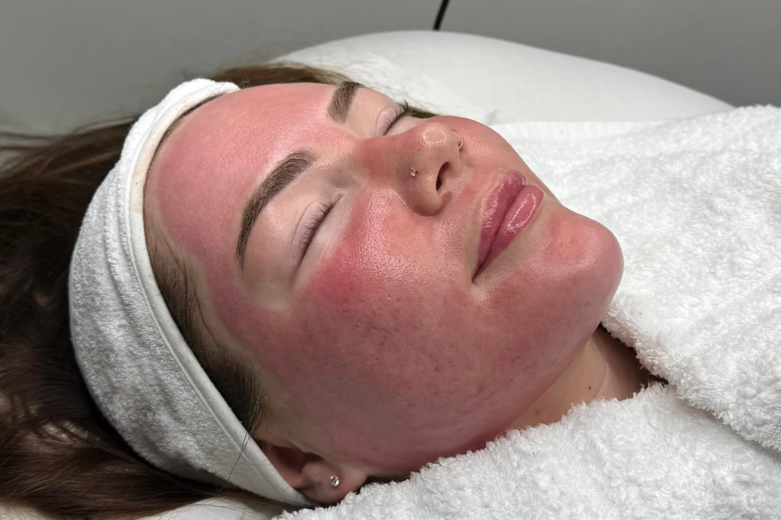 PRF Microneedling