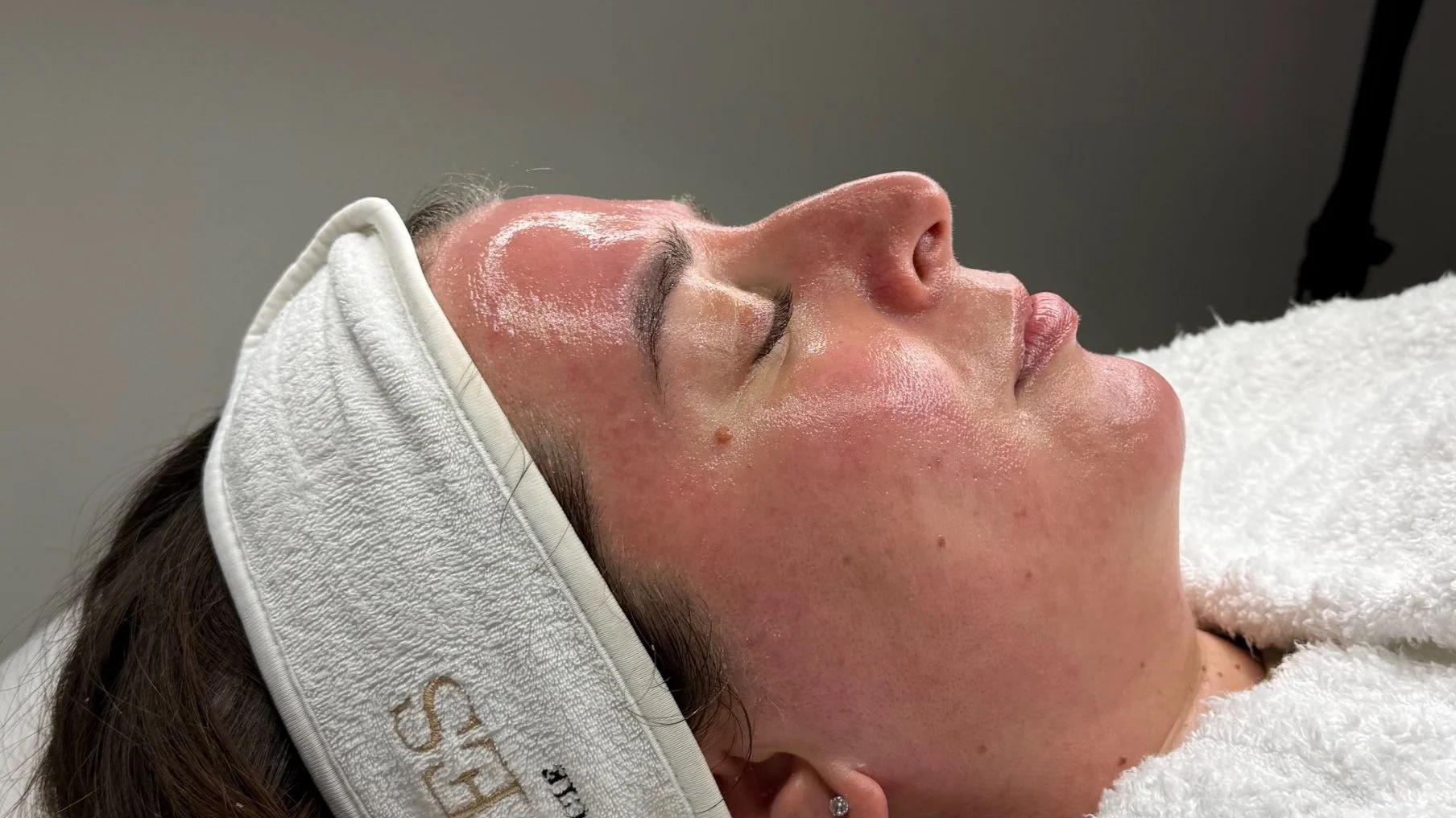 Dermaplaning